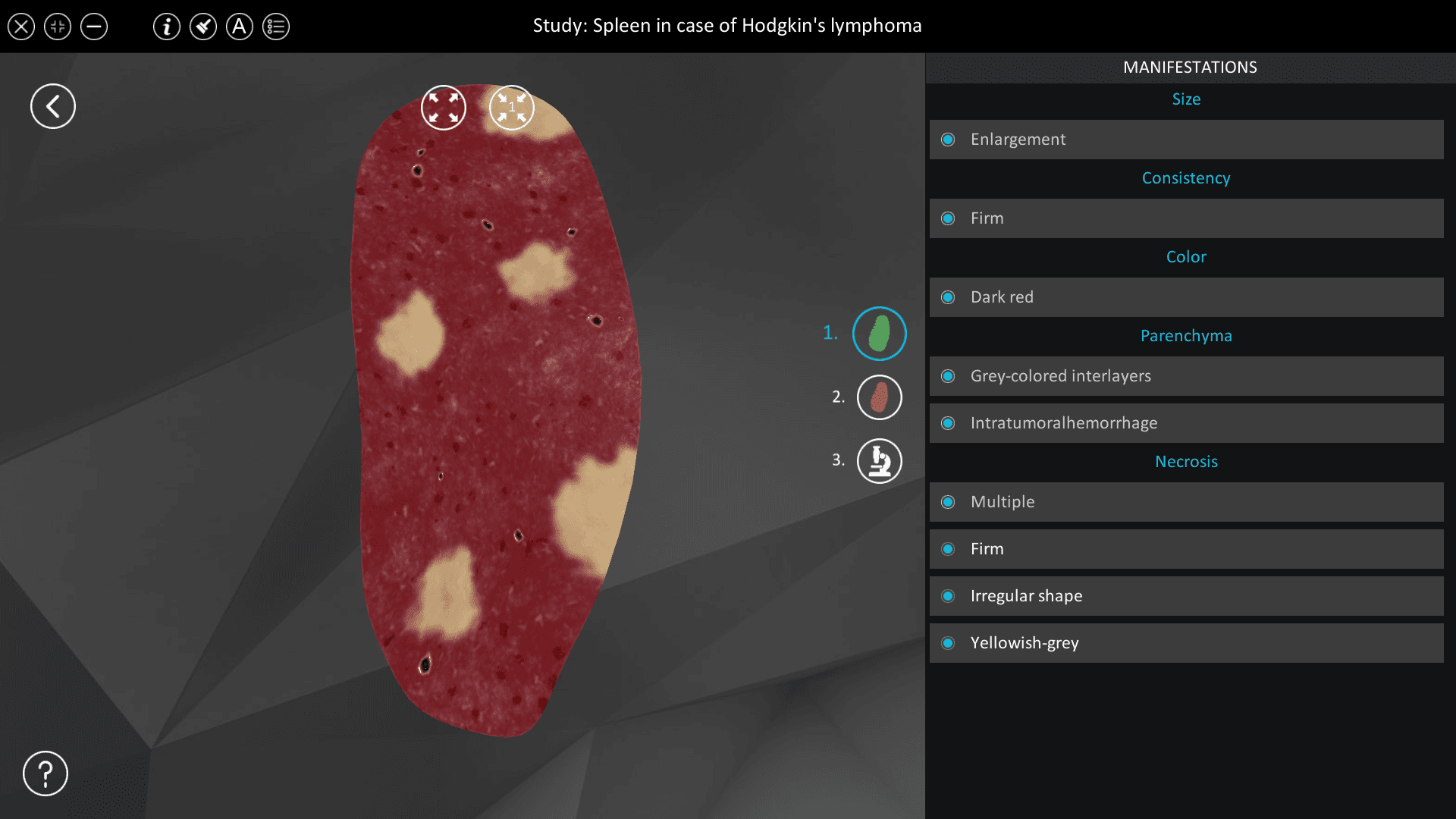 Spleen in case of Hodgkin’s lymphoma