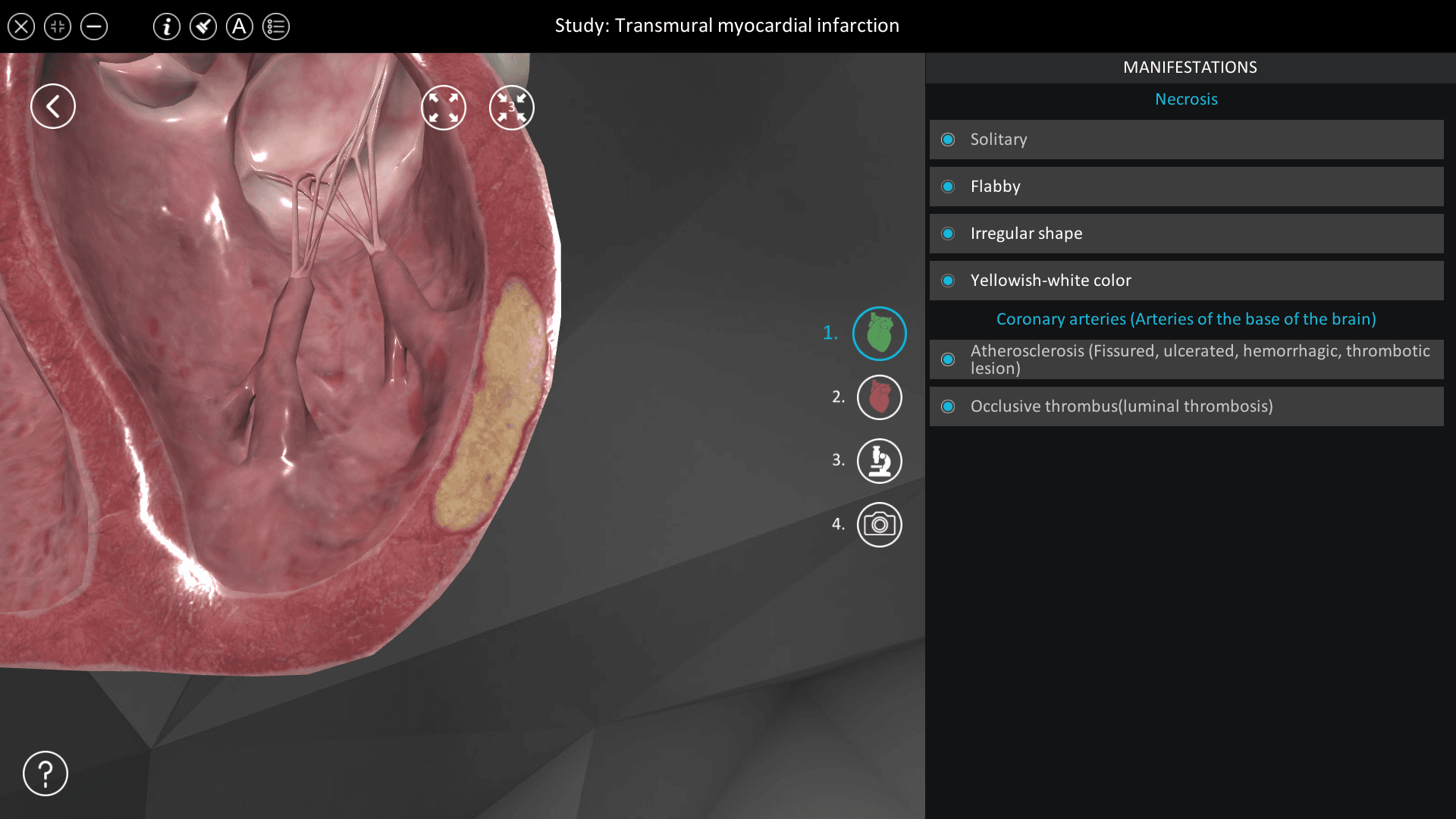 Transmural myocardial infarction