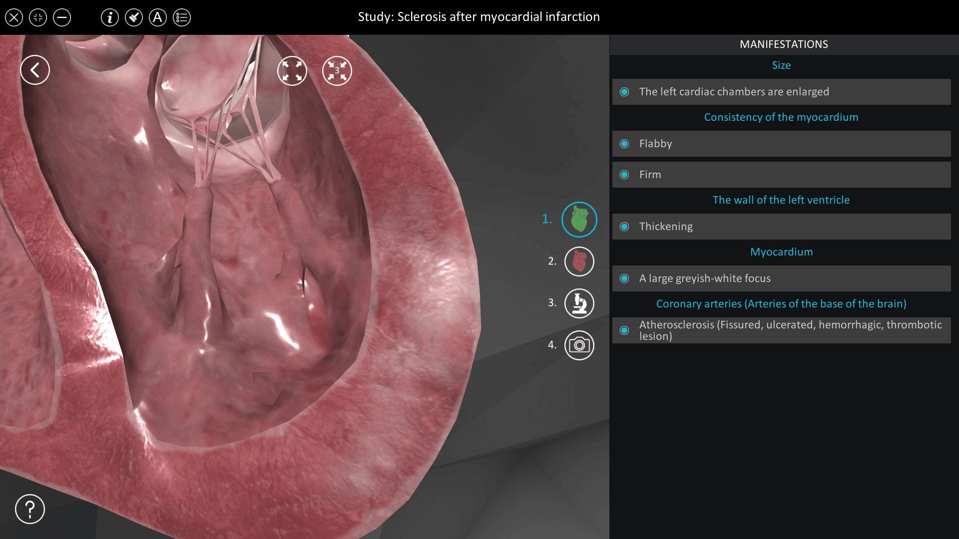 Sclerosis after myocardial infarction