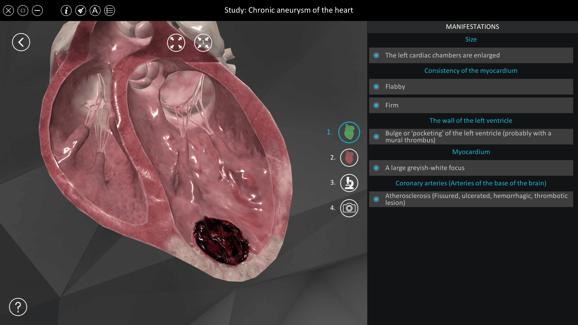 Chronic aneurysm of the heart