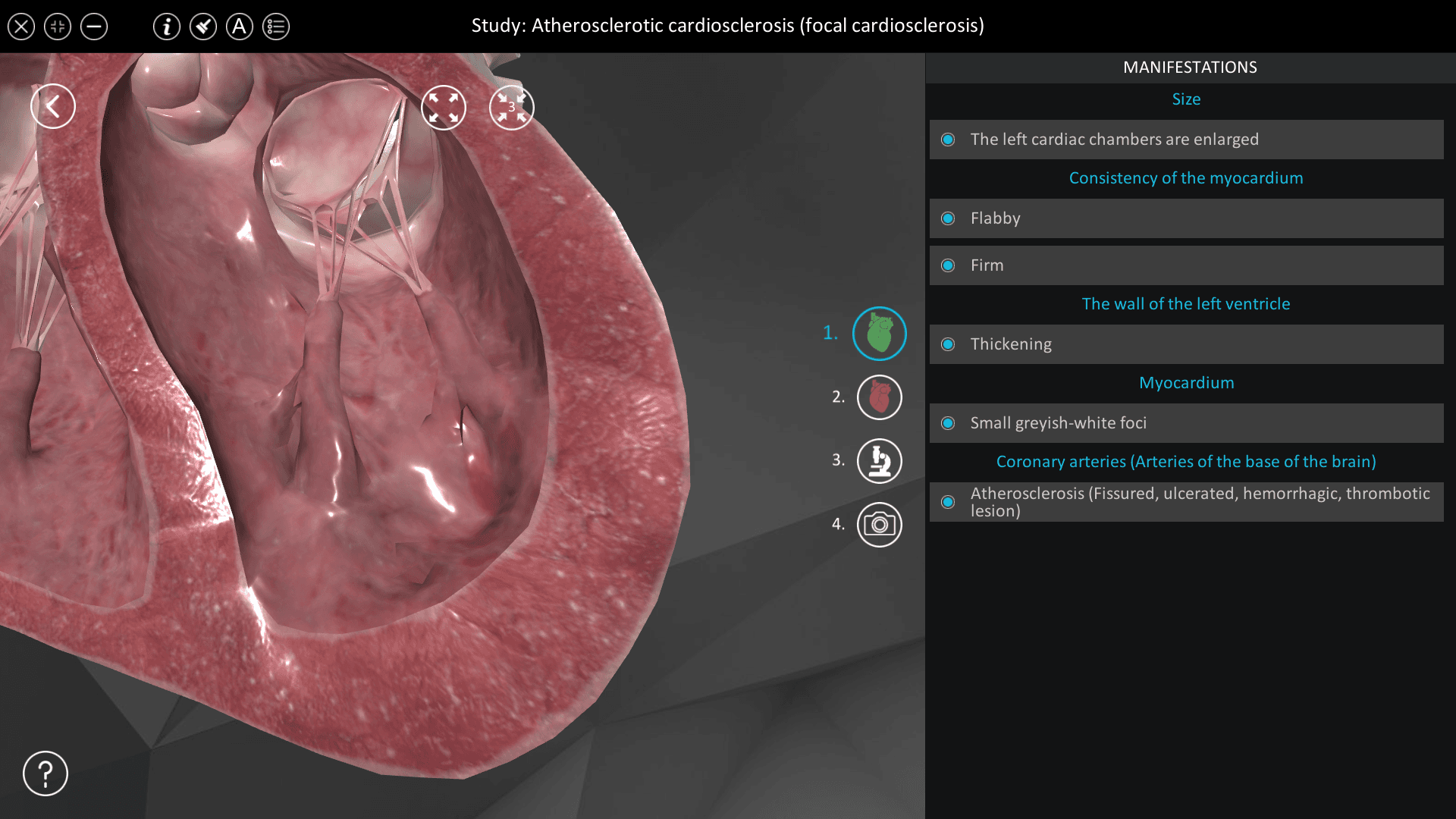 Atherosclerotic cardiosclerosis (focal cardiosclerosis)