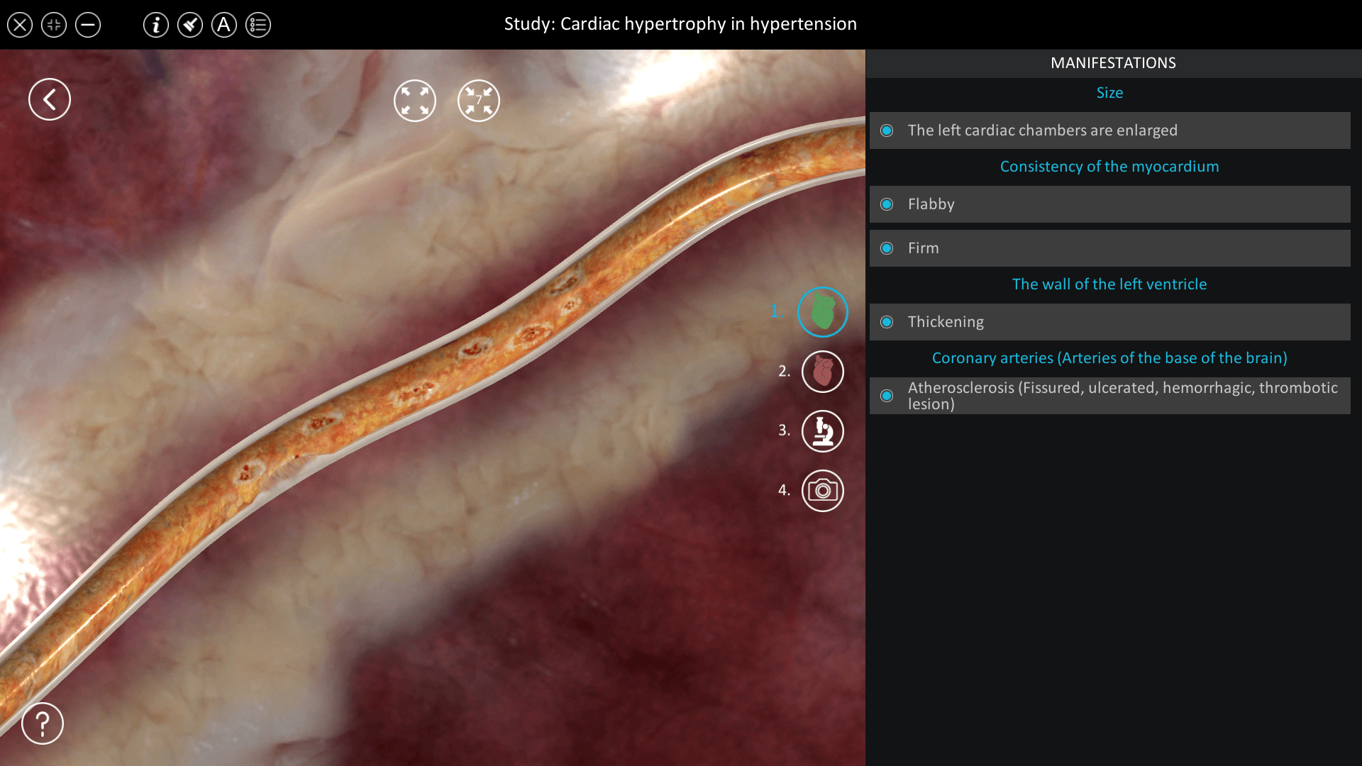 Cardiac hypertrophy in hypertension