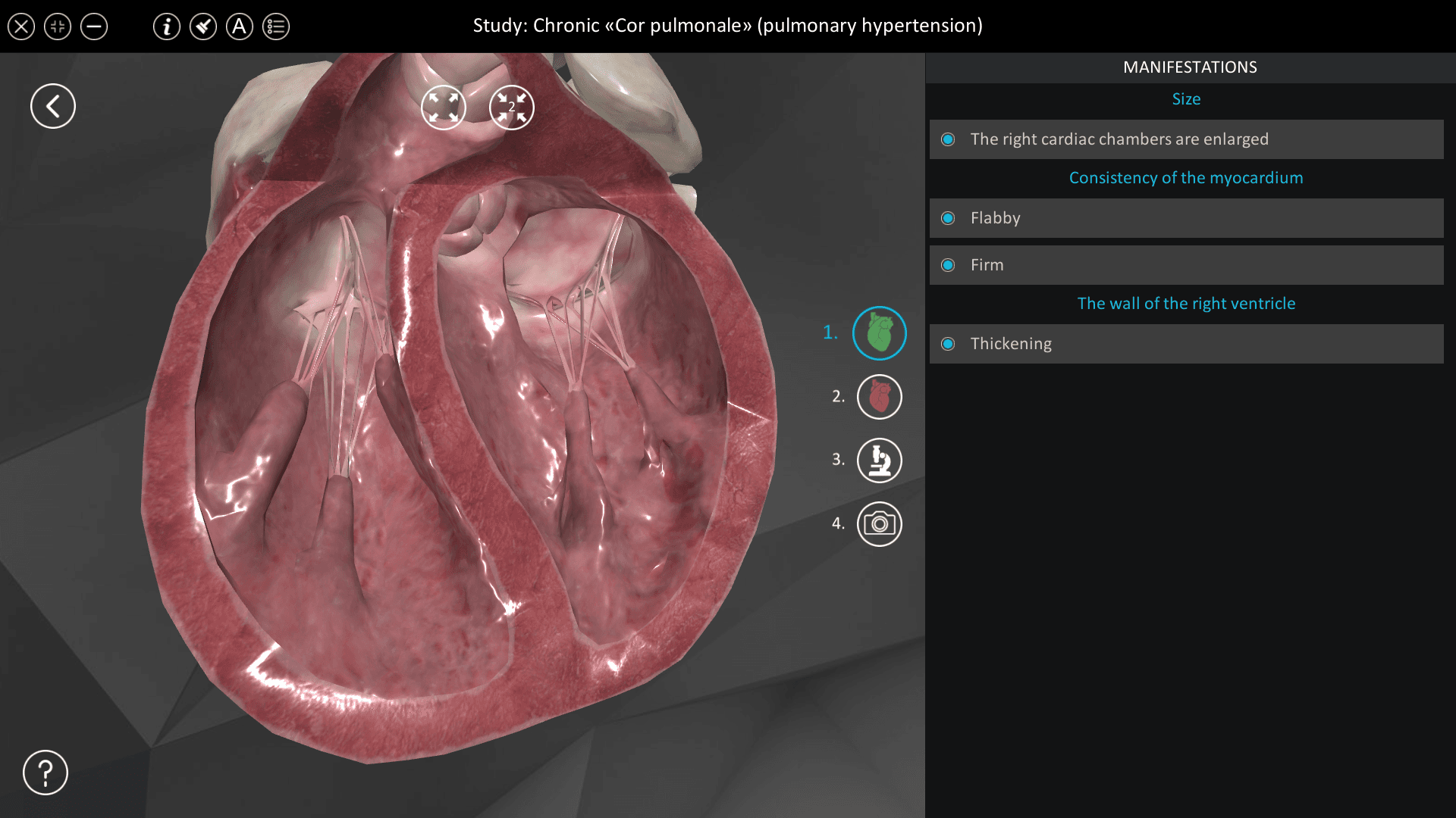 Chronic “Cor pulmonale” (pulmonary hypertension)