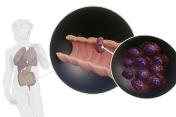 Cancer cells
