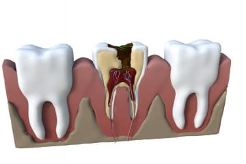 Tooth decay