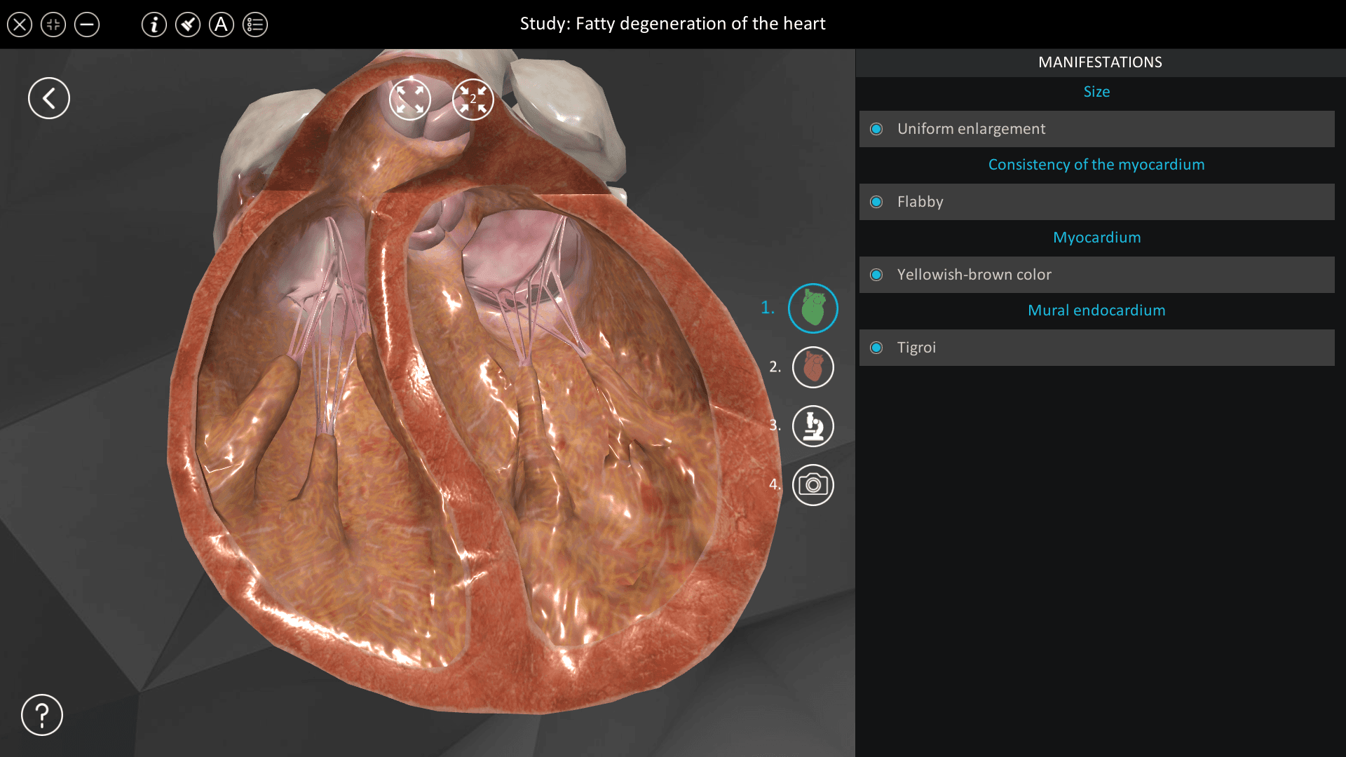 Fatty degeneration of the heart