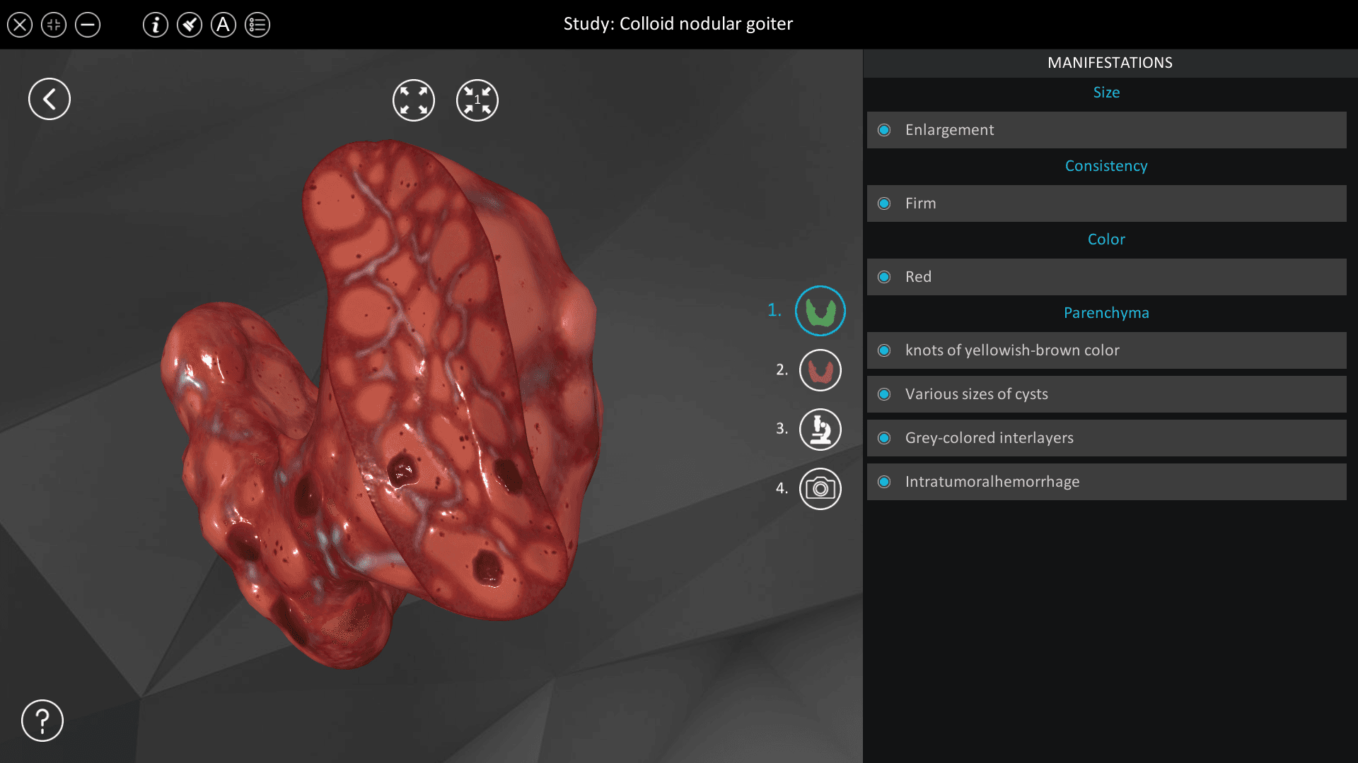 Colloid nodular goiter
