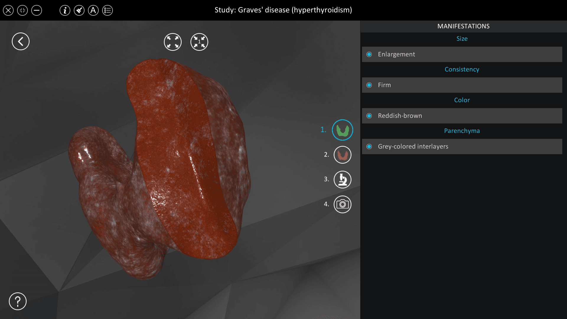 Graves’ disease (hyperthyroidism)
