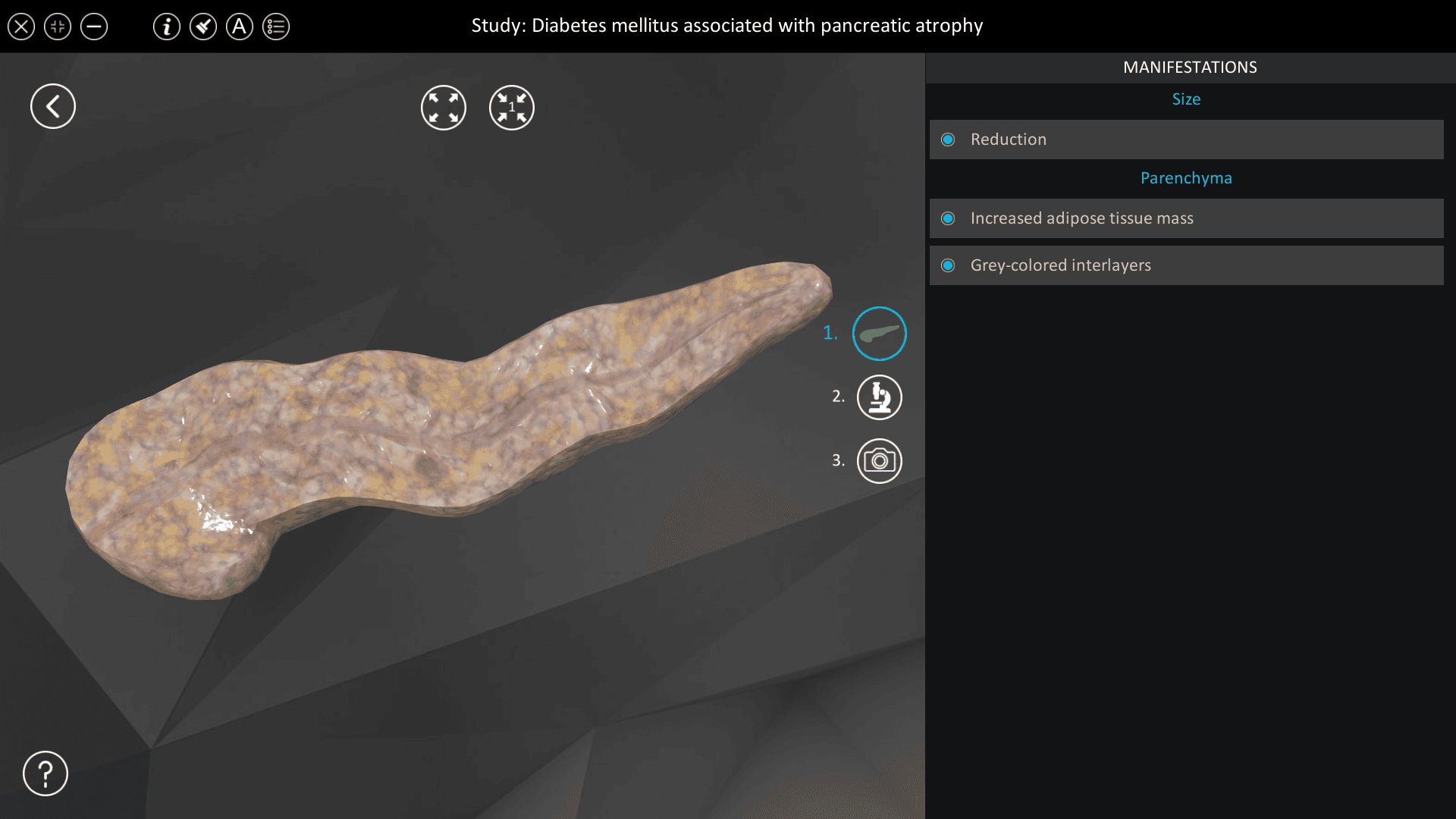 Diabetes mellitus associated with pancreatic atrophy