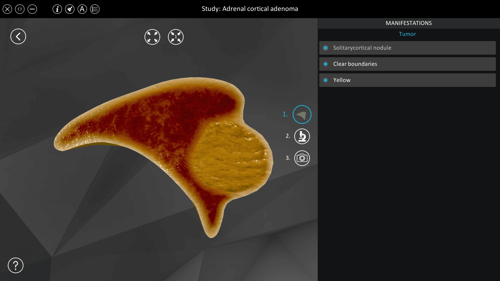 Adrenal cortical adenoma