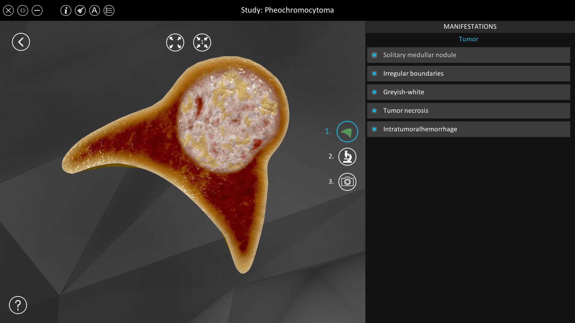 Pheochromocytoma