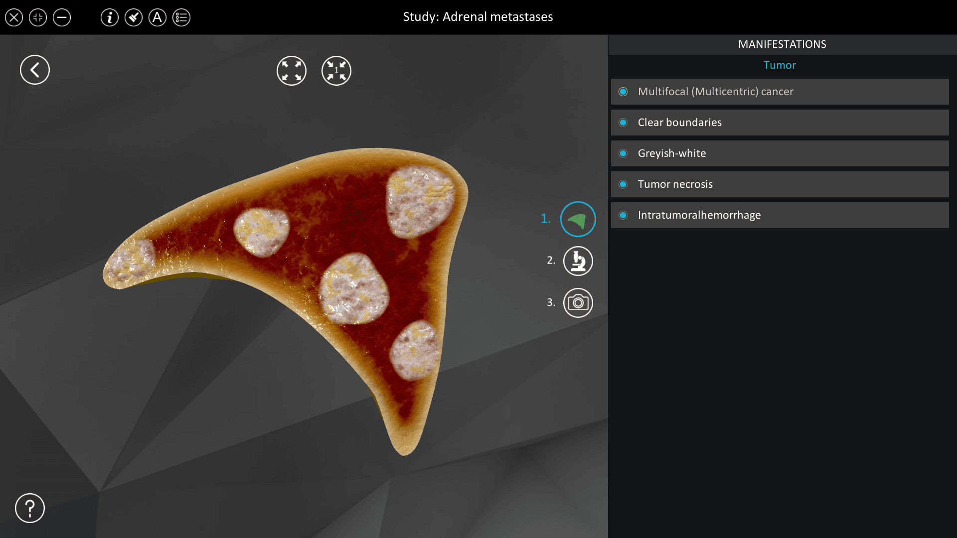Adrenal metastases