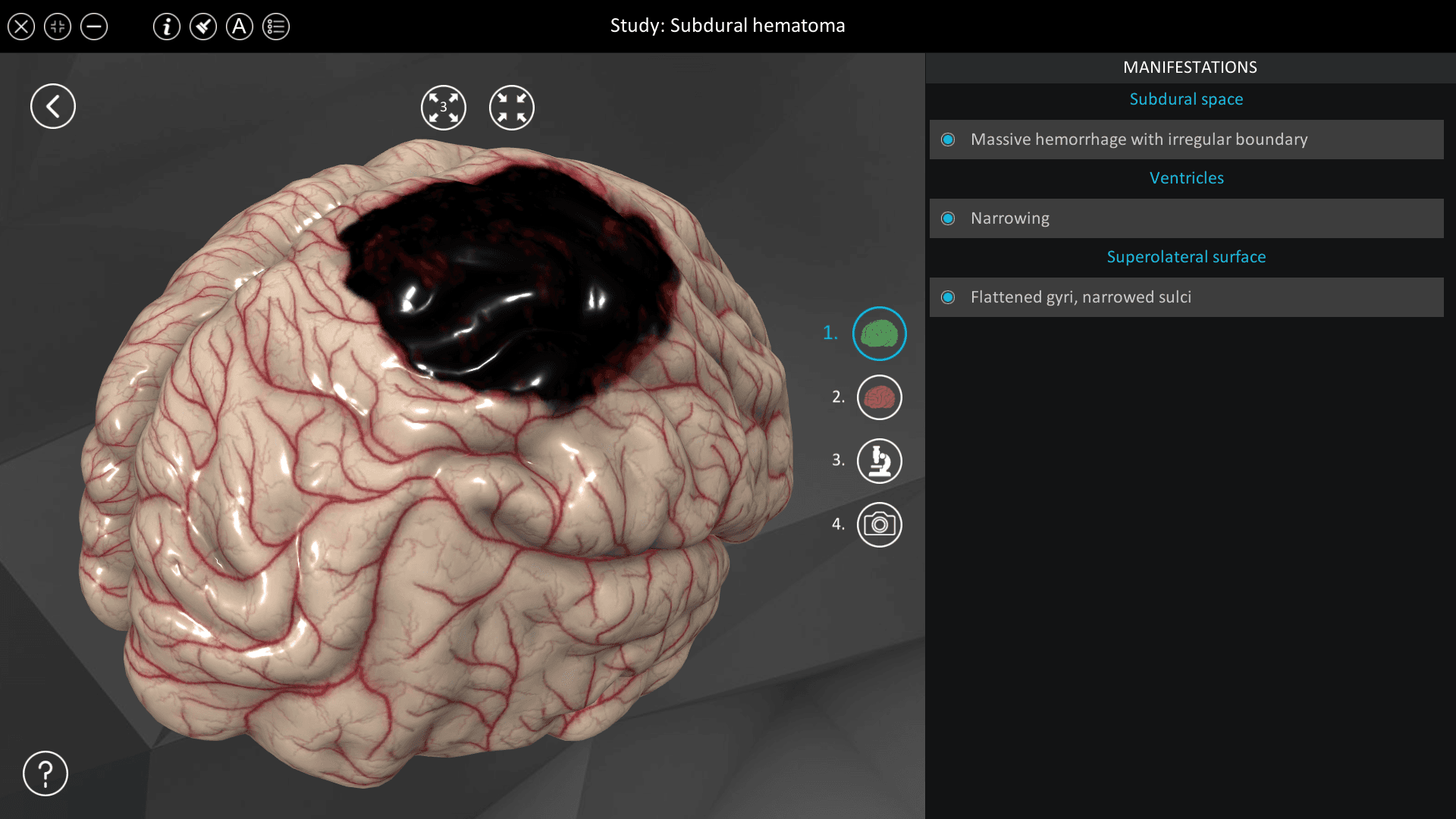 Subdural hematoma