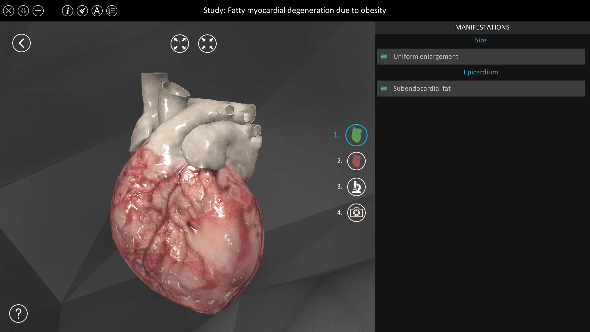 Fatty myocardial degeneration due to obesity