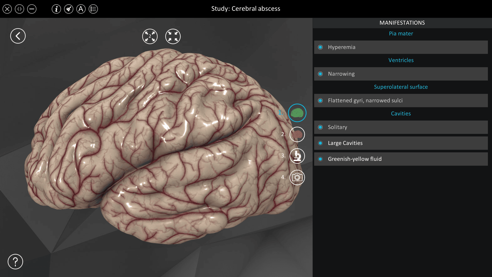 Cerebral abscess