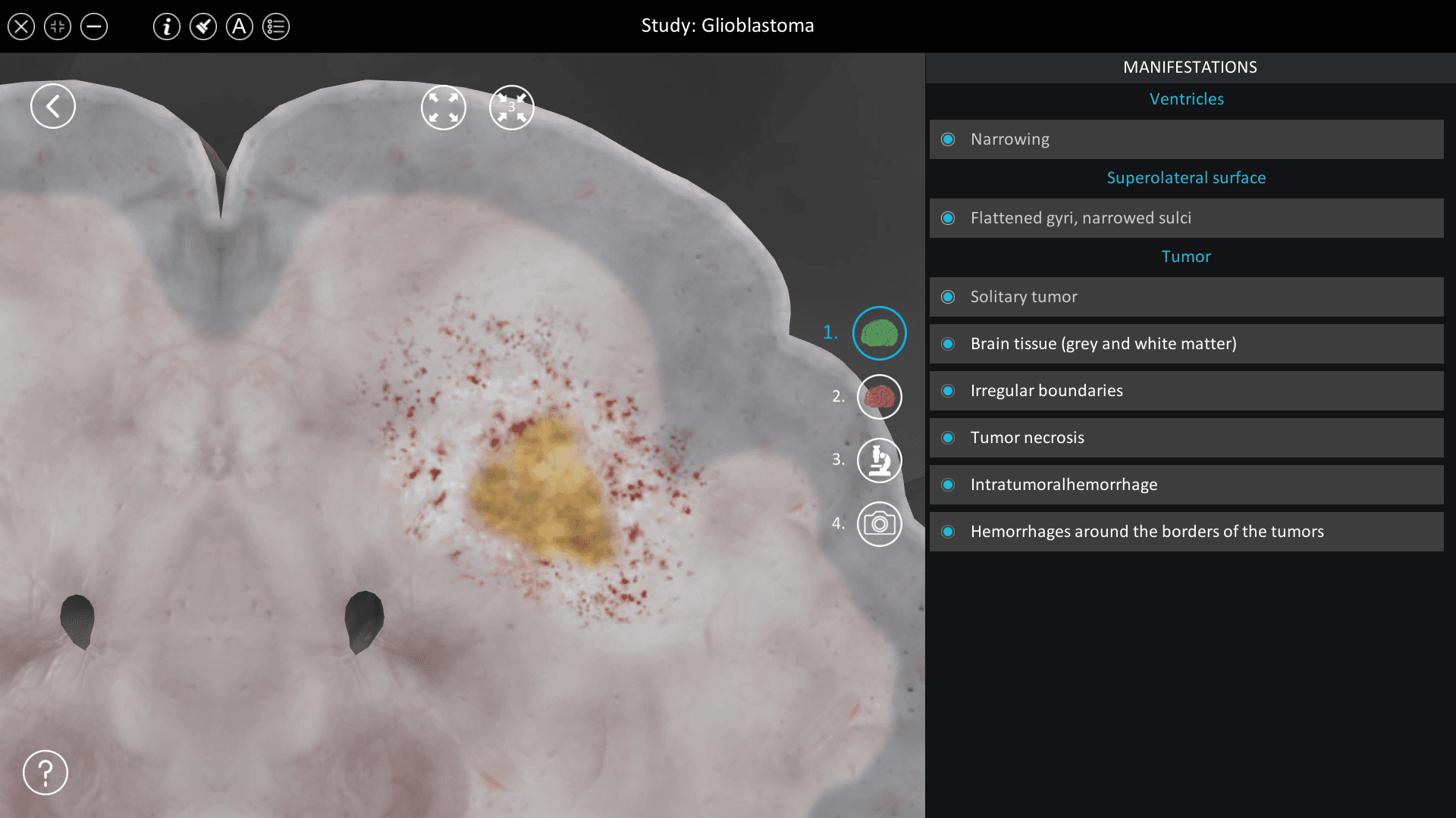 Glioblastoma