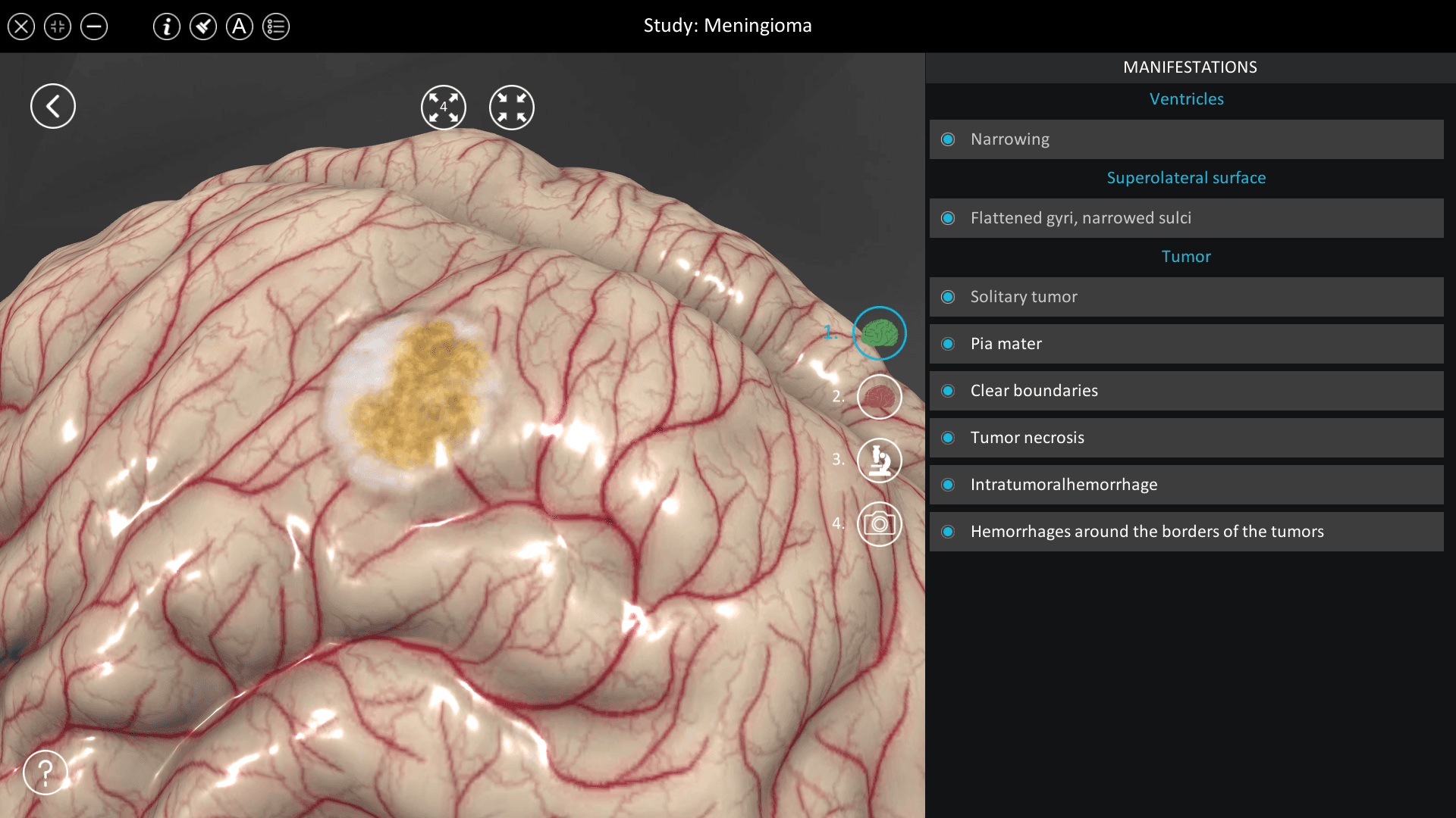 Meningioma
