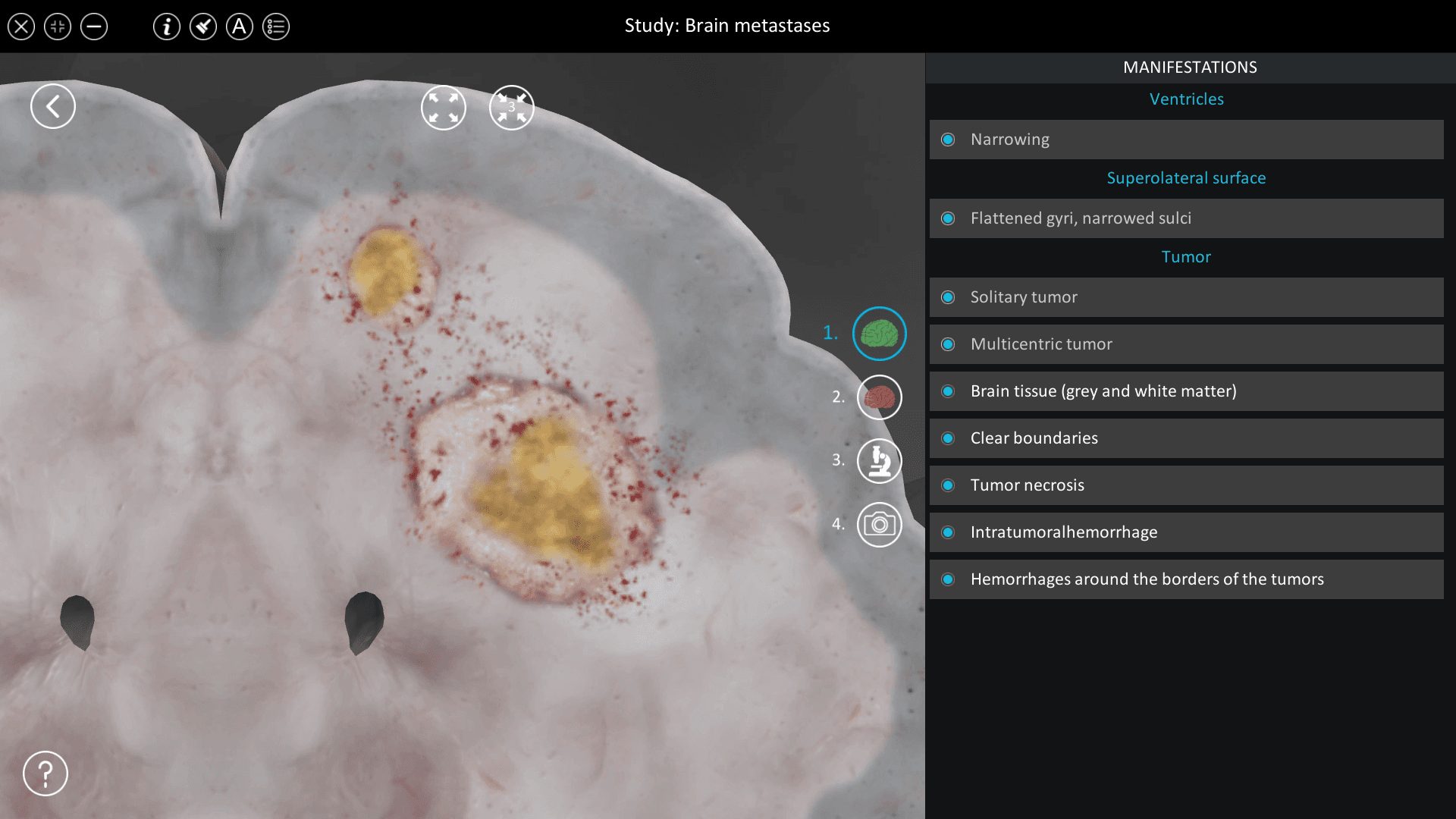 Brain metastases