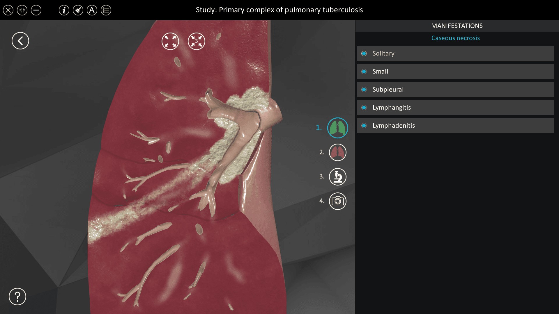 Primary complex of pulmonary tuberculosis