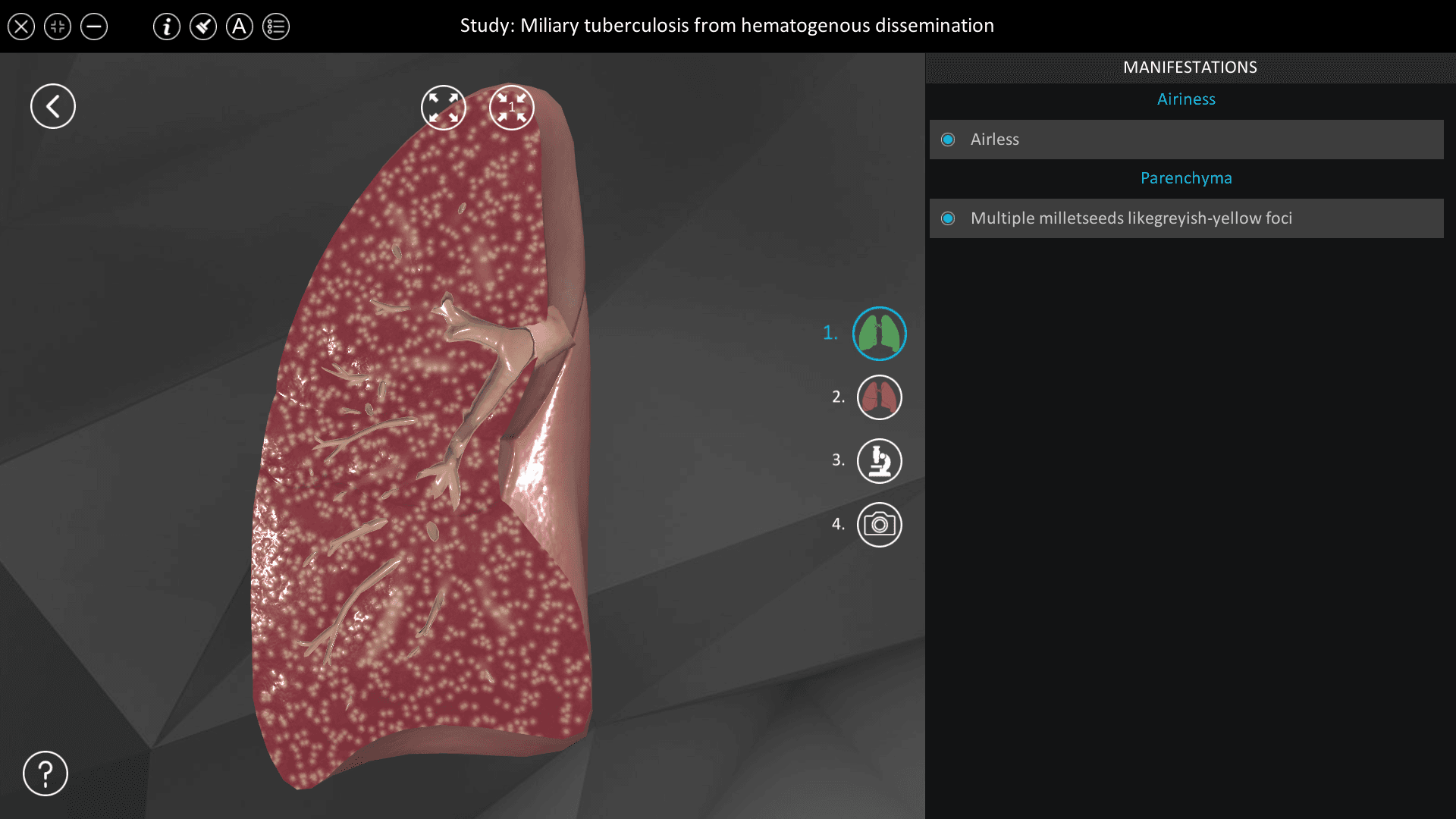 Miliary tuberculosis from hematogenous dissemination