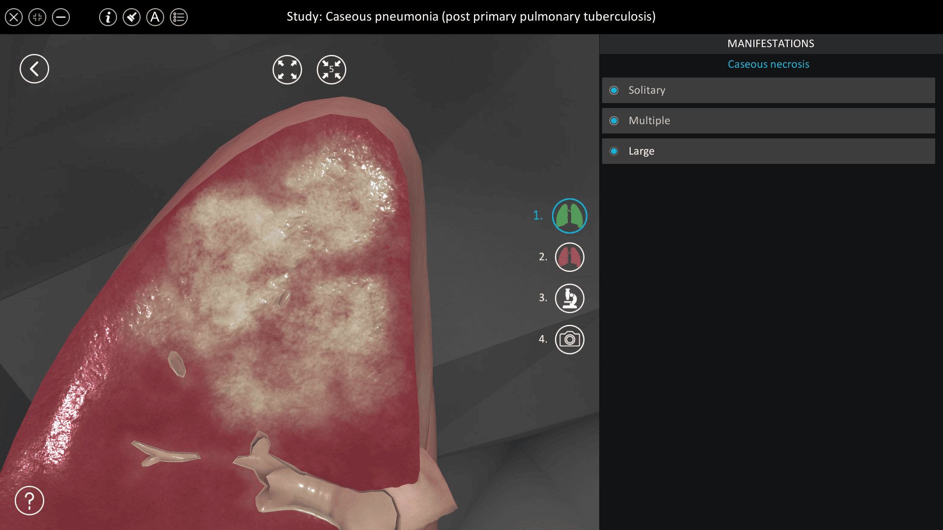 Caseous pneumonia