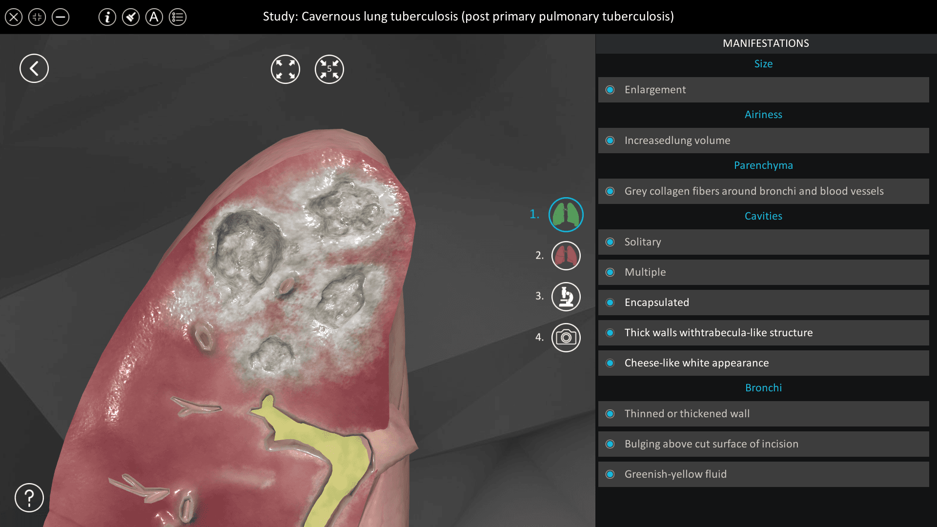 Cavernous lung tuberculosis