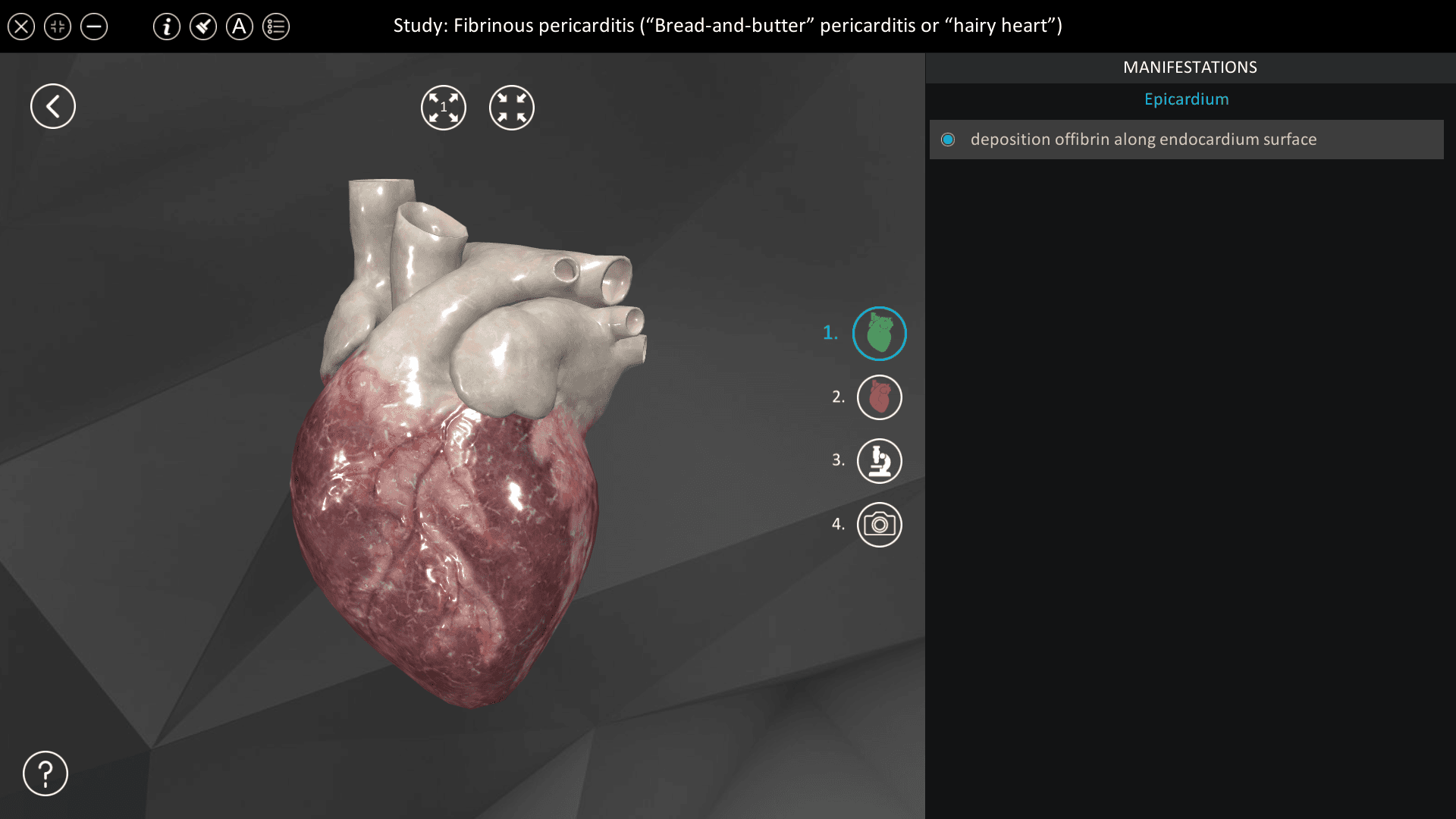 Fibrinous pericarditis (“Bread-and-butter” pericarditis)