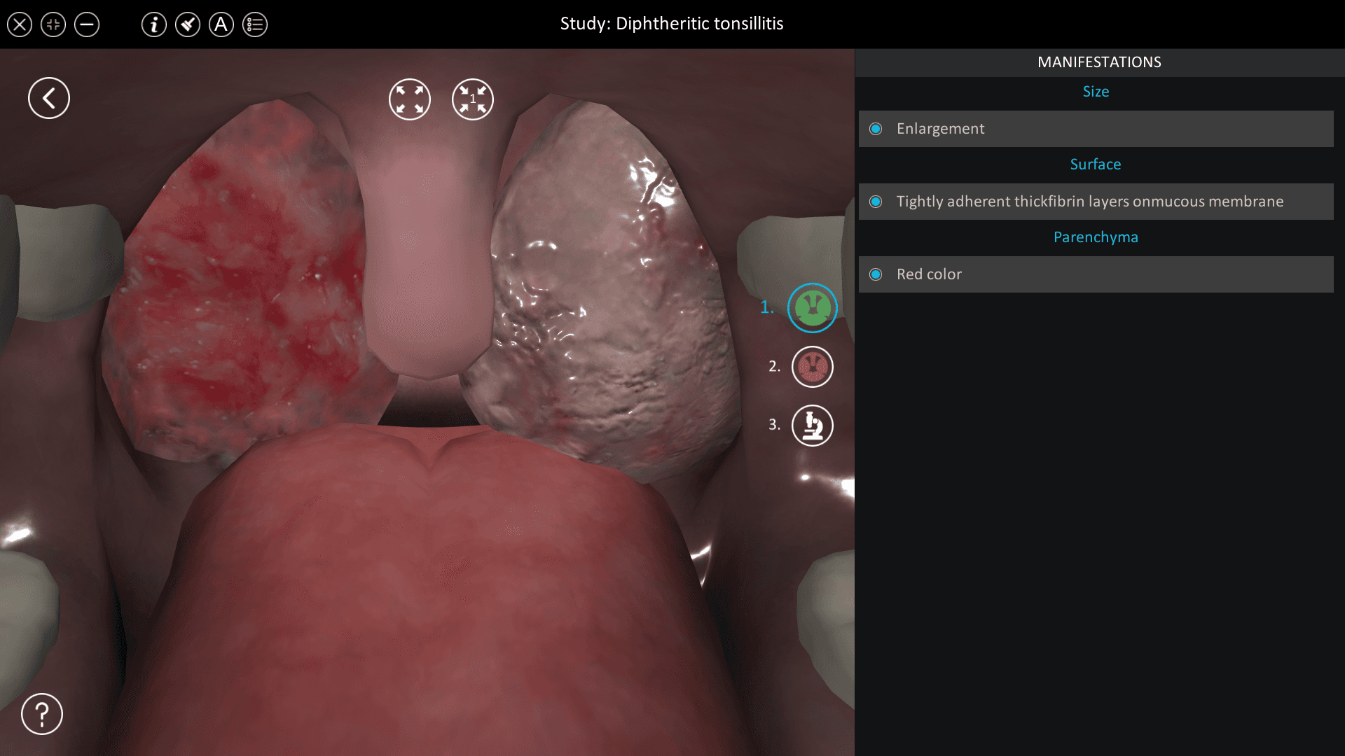 Diphtheritic tonsillitis