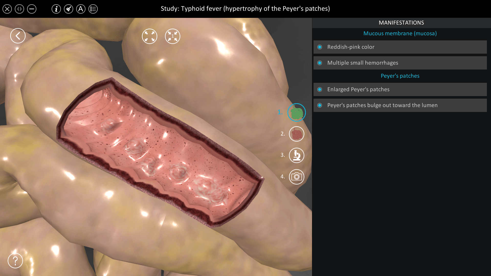 Typhoid fever (hypertrophy of the Peyer’s patches)