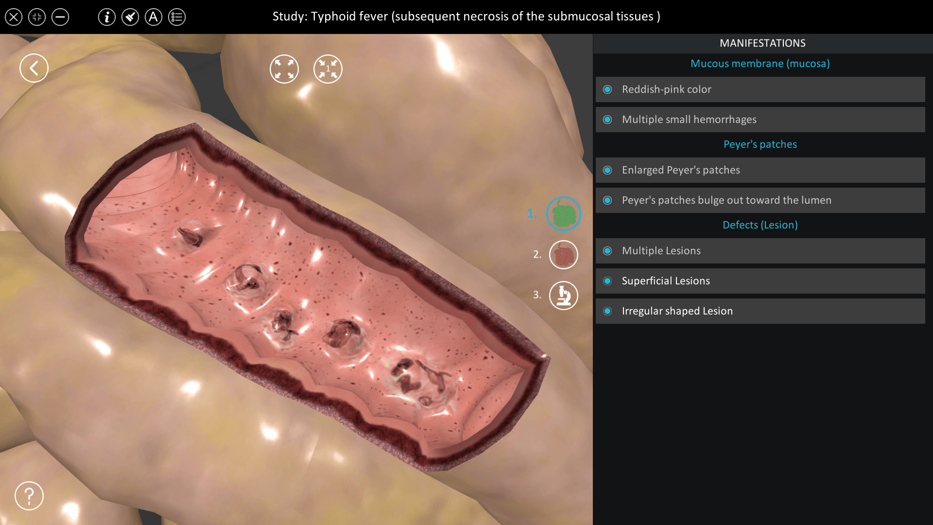 Typhoid fever (subsequent necrosis of the submucosal tissues)