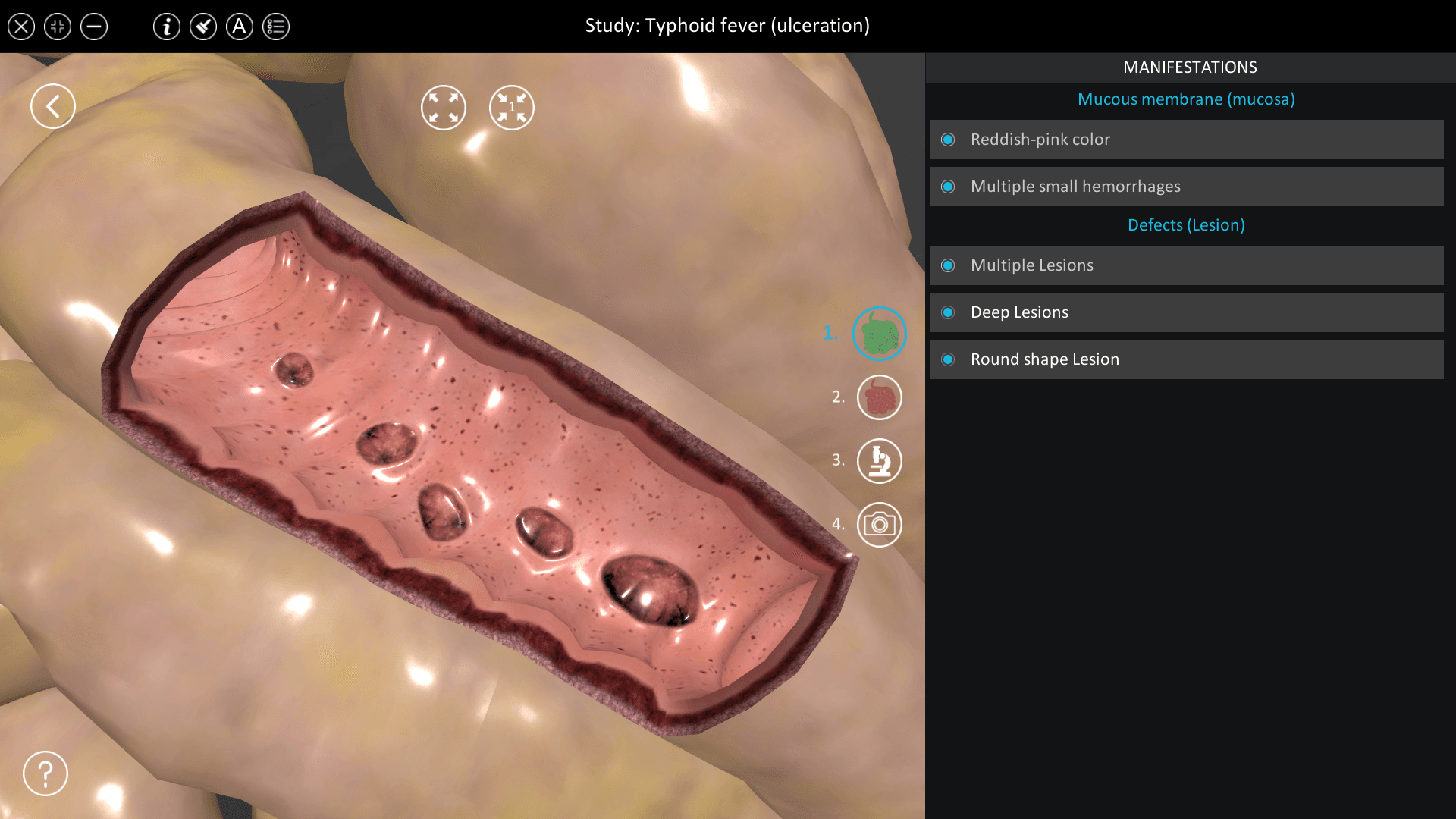 Typhoid fever (ulceration)