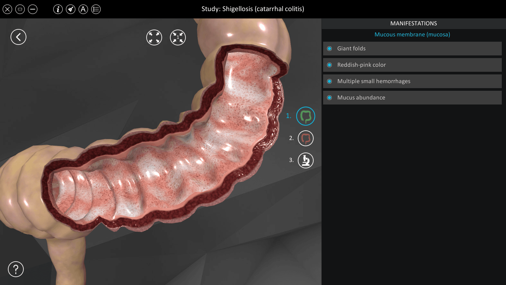 Shigellosis (catarrhal colitis)