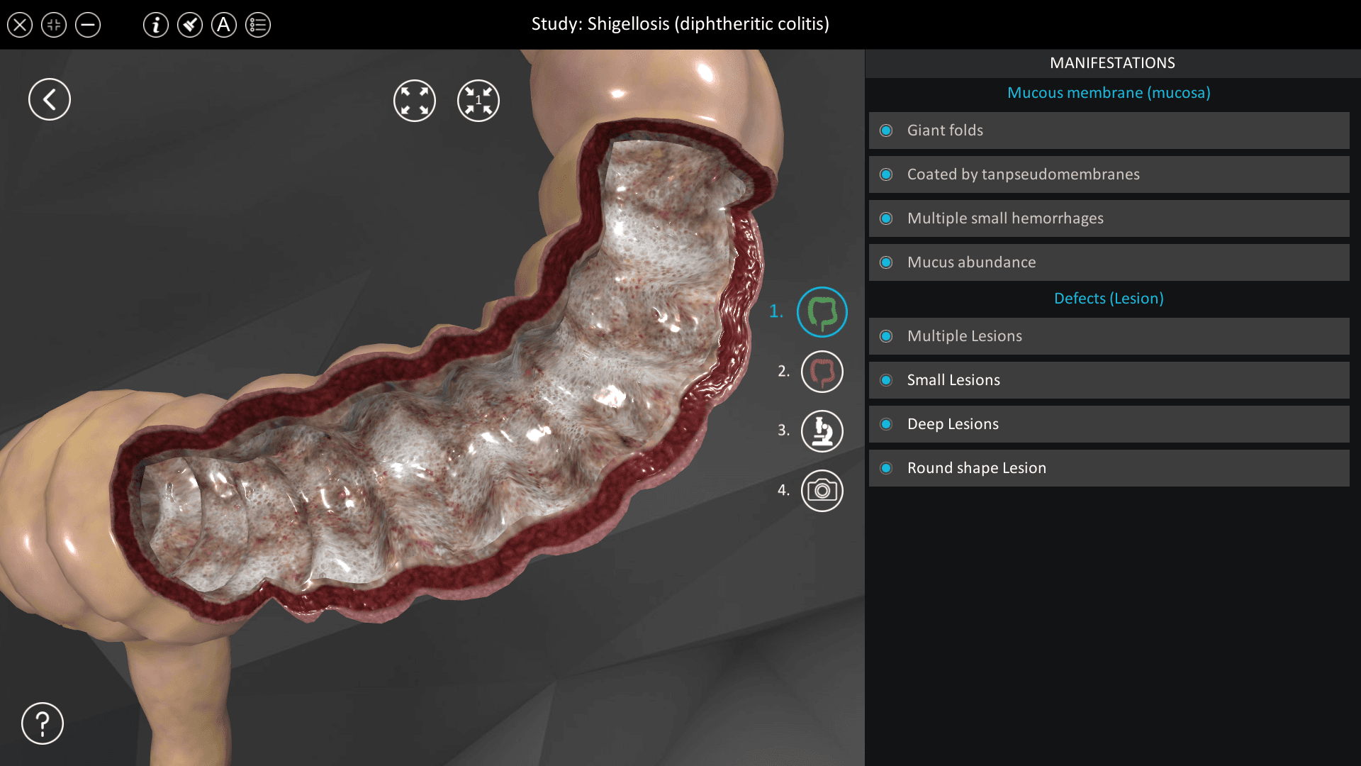 Shigellosis (diphtheritic colitis)