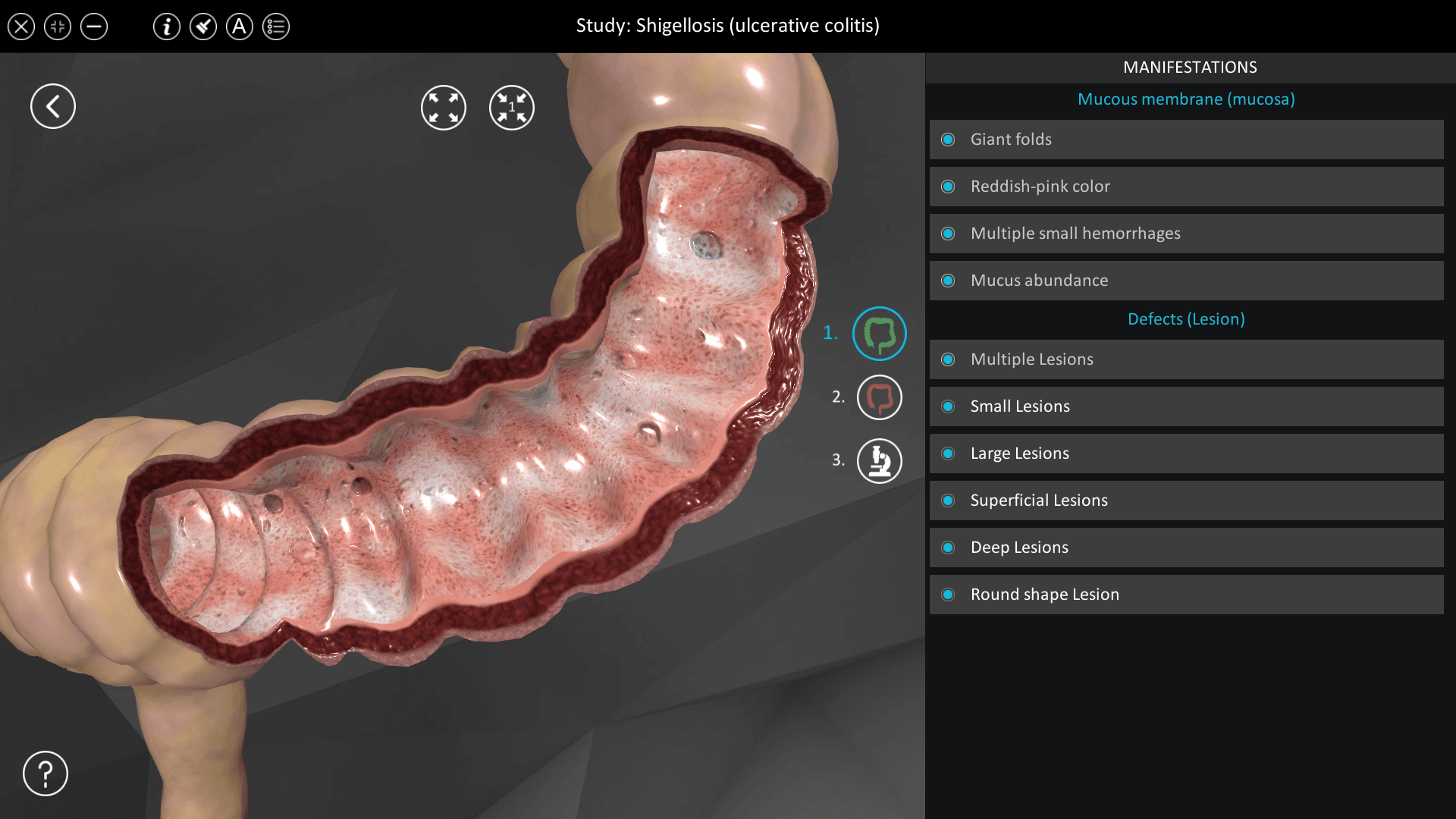 Shigellosis (ulcerative colitis)