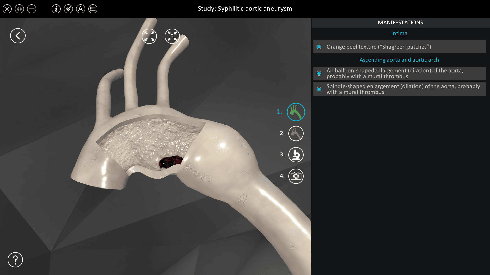 Syphilitic aortic aneurysm