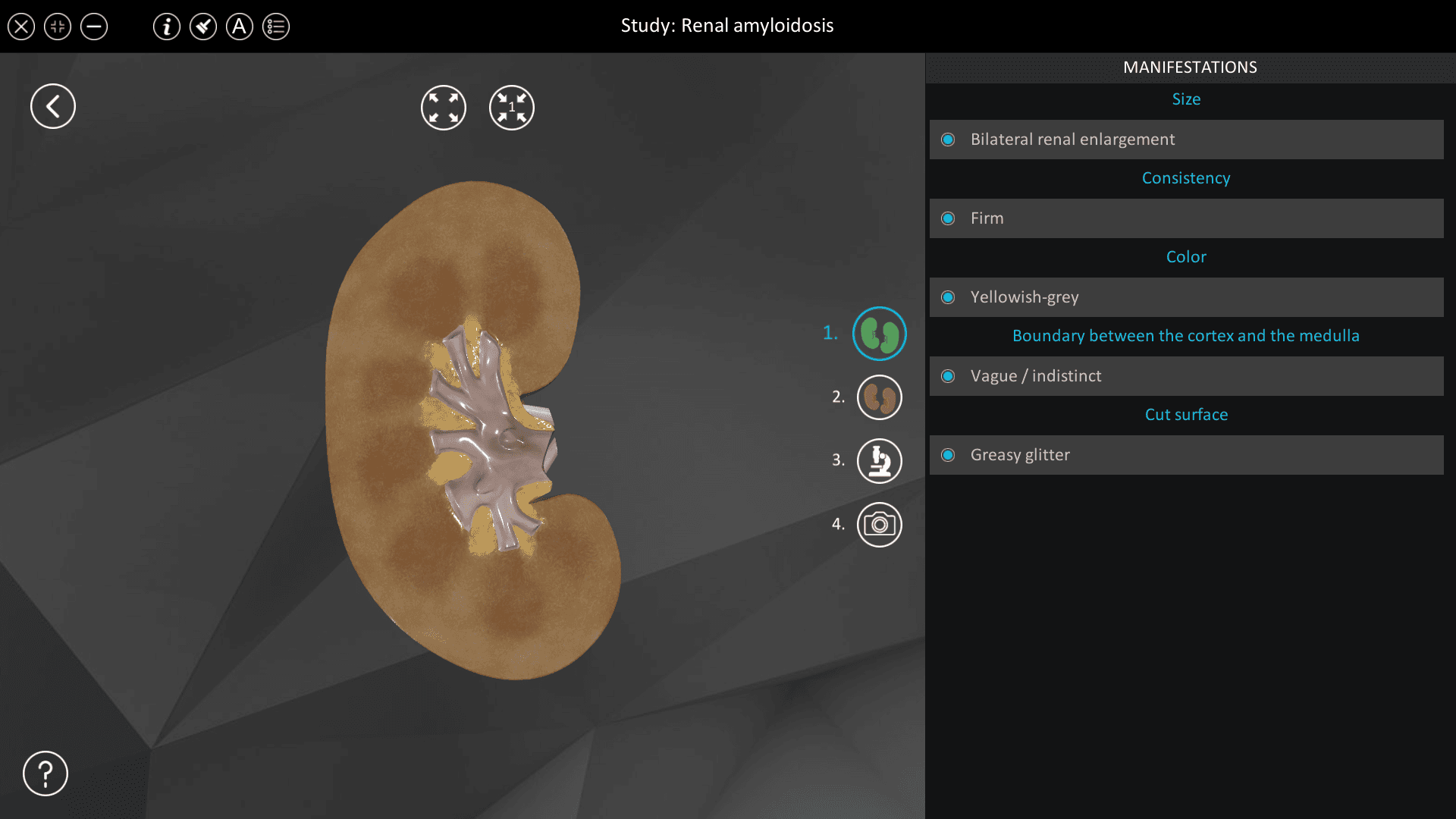 Renal amyloidosis