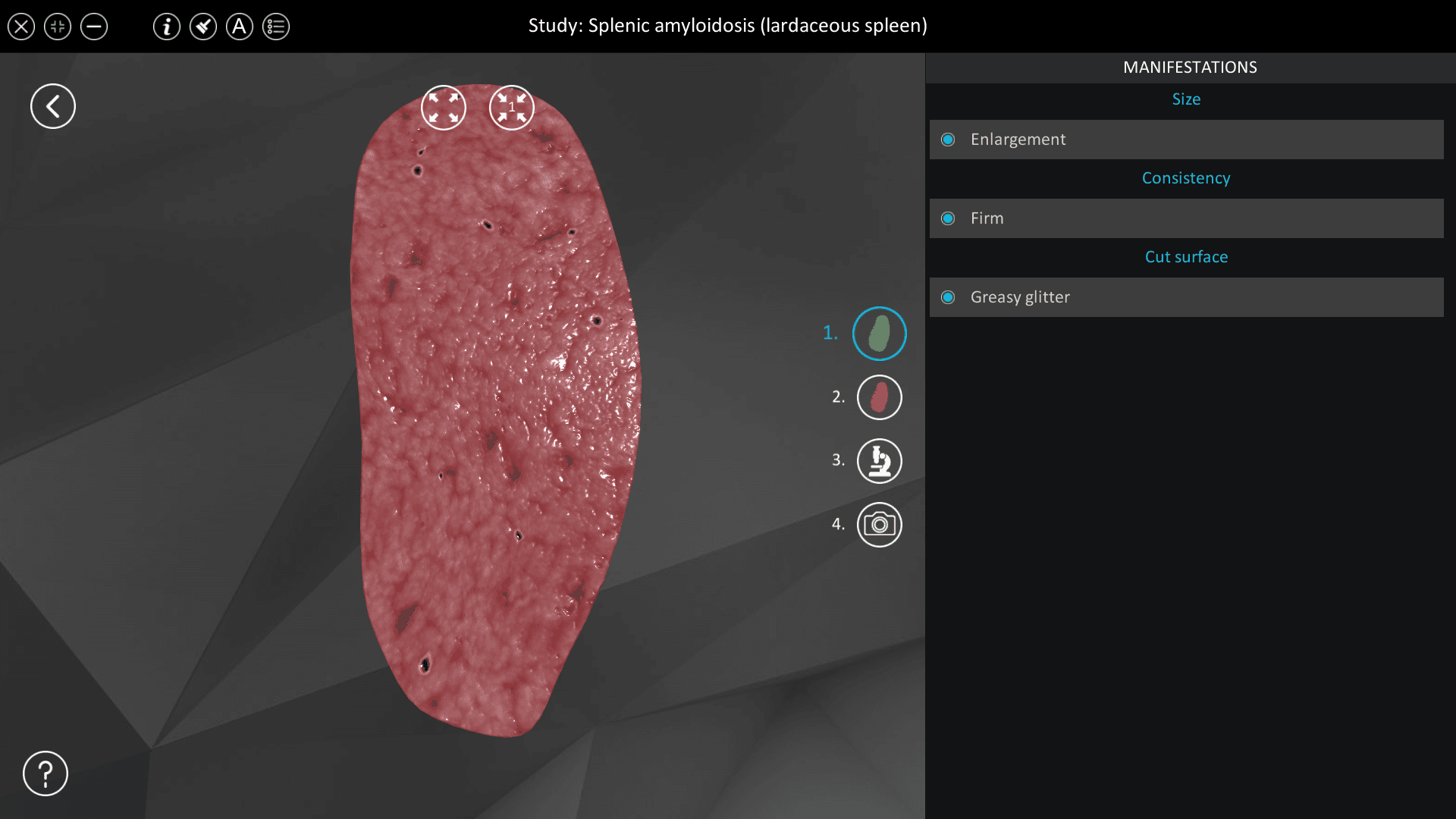 Splenic amyloidosis (lardaceous spleen)