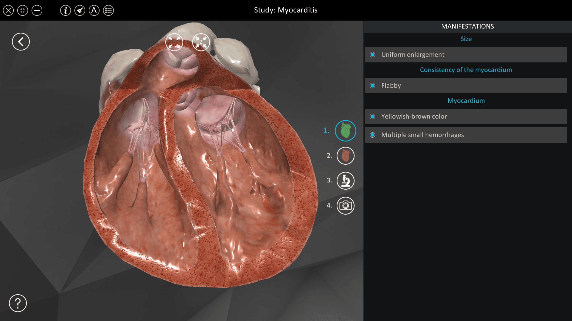 Myocarditis