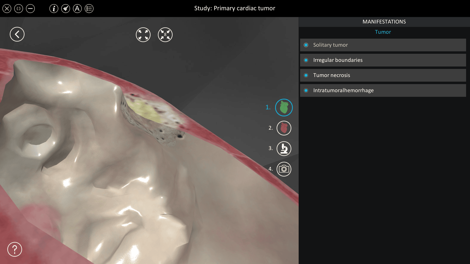 Primary cardiac tumor