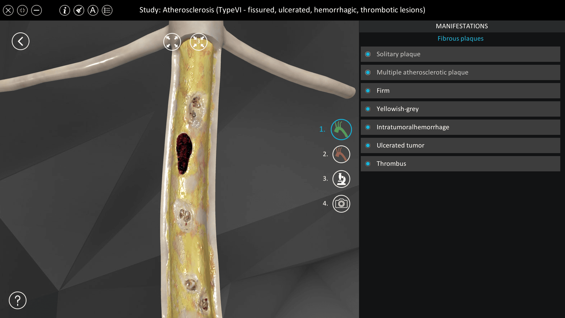 Atherosclerosis (Type VI)