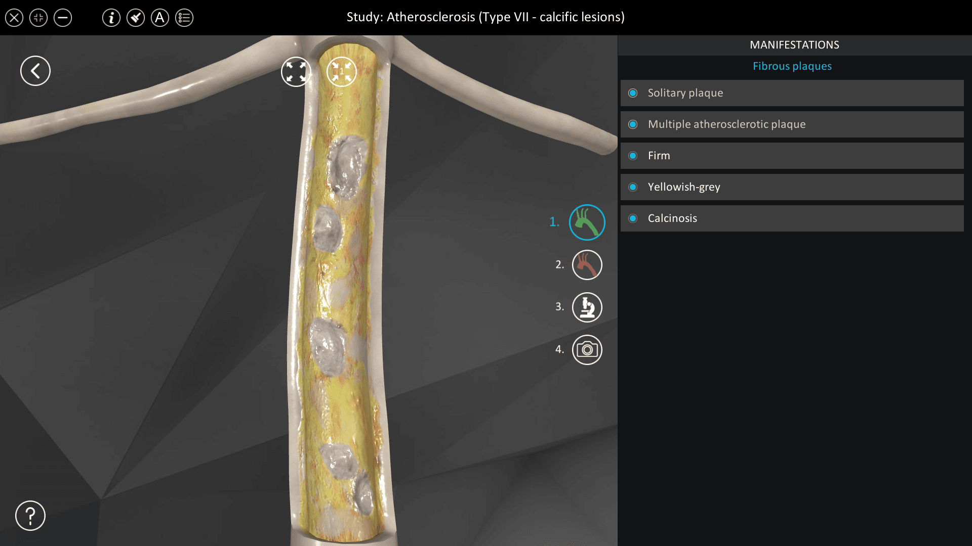 Atherosclerosis (Type VII)