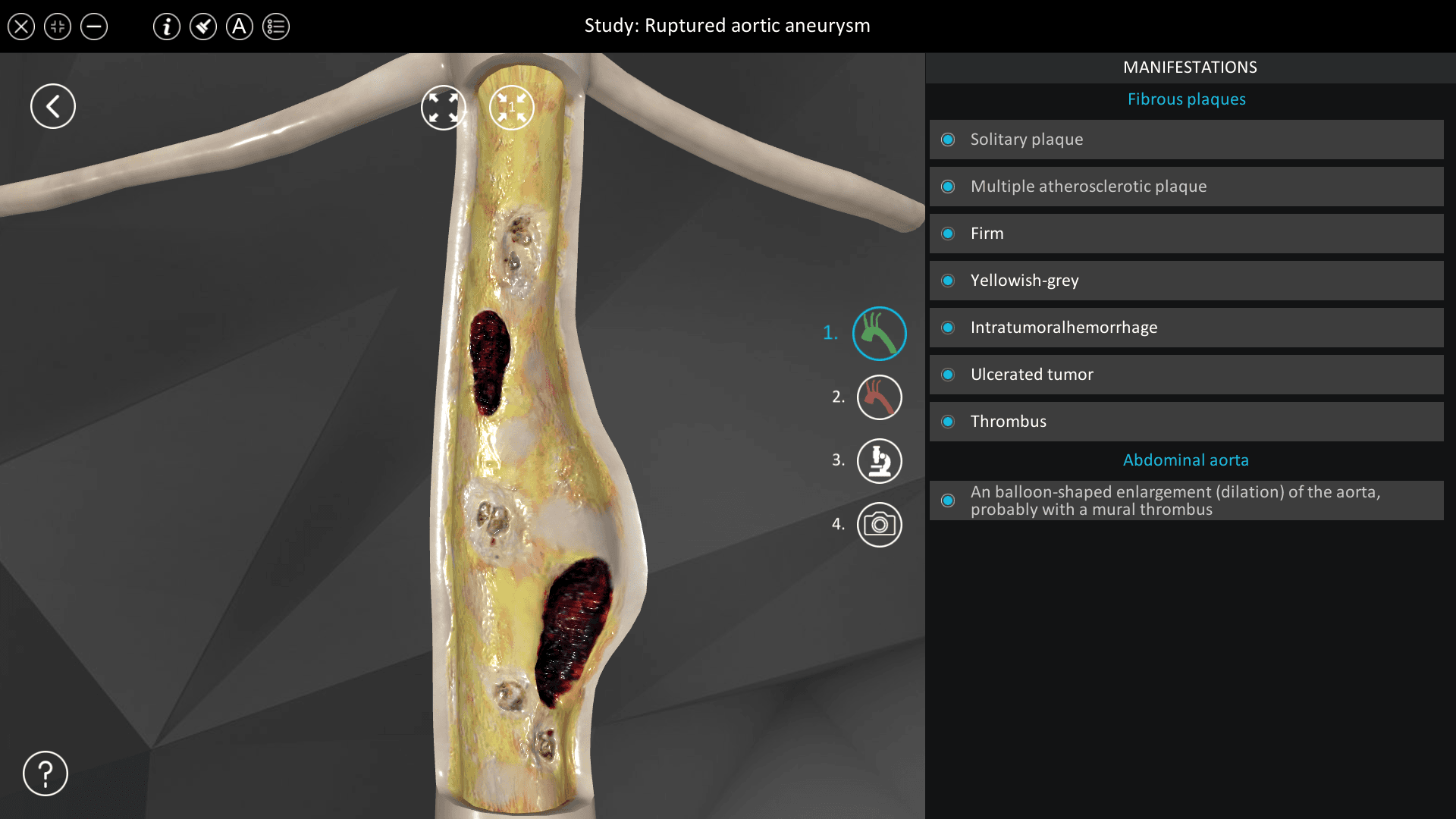 Ruptured aortic aneurysm