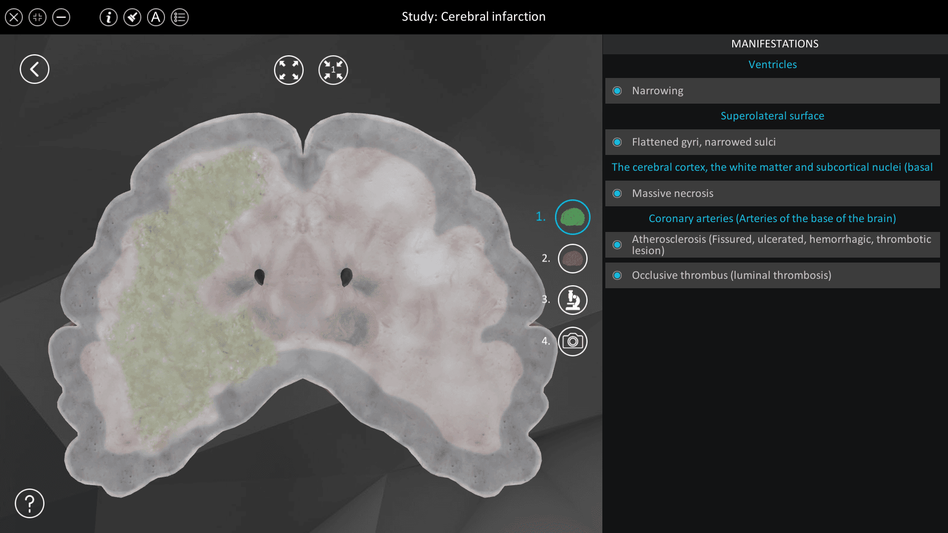 Cerebral infarction