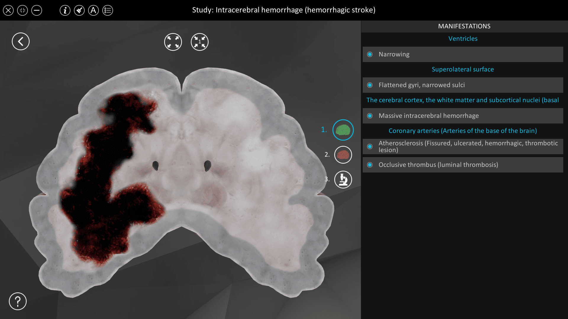 Intracerebral hemorrhage (hemorrhagic stroke)