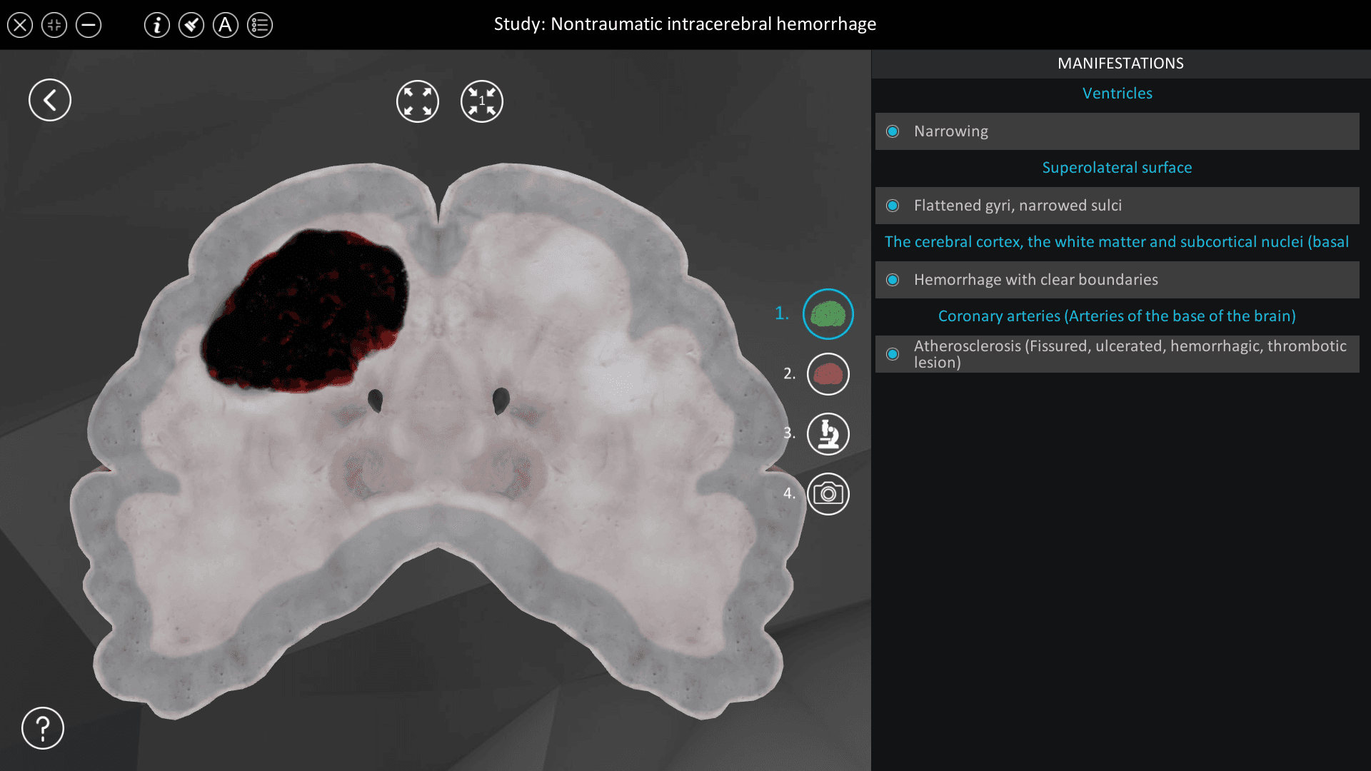 Nontraumatic intracerebral hemorrhage