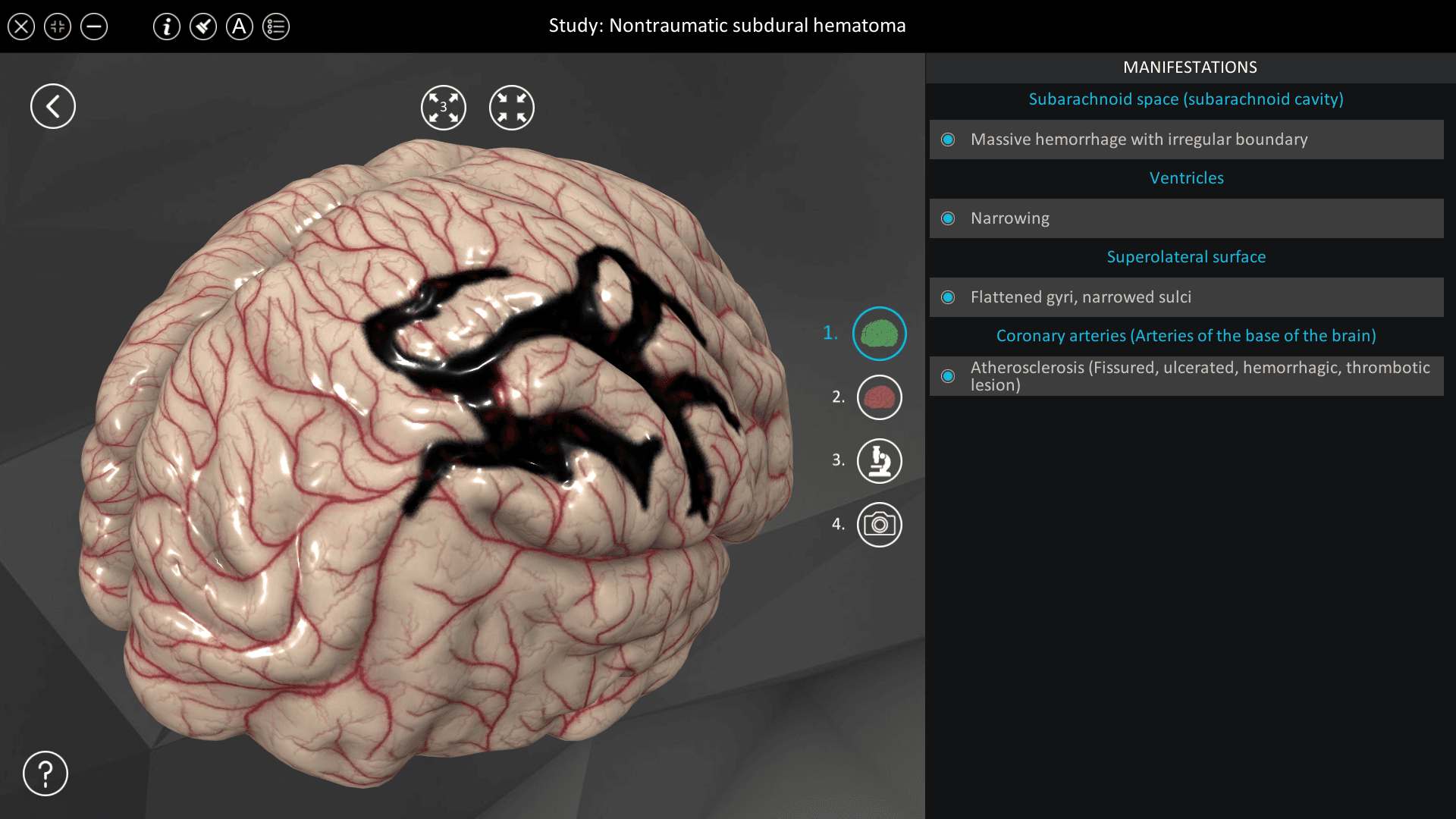 Nontraumatic subdural hematoma