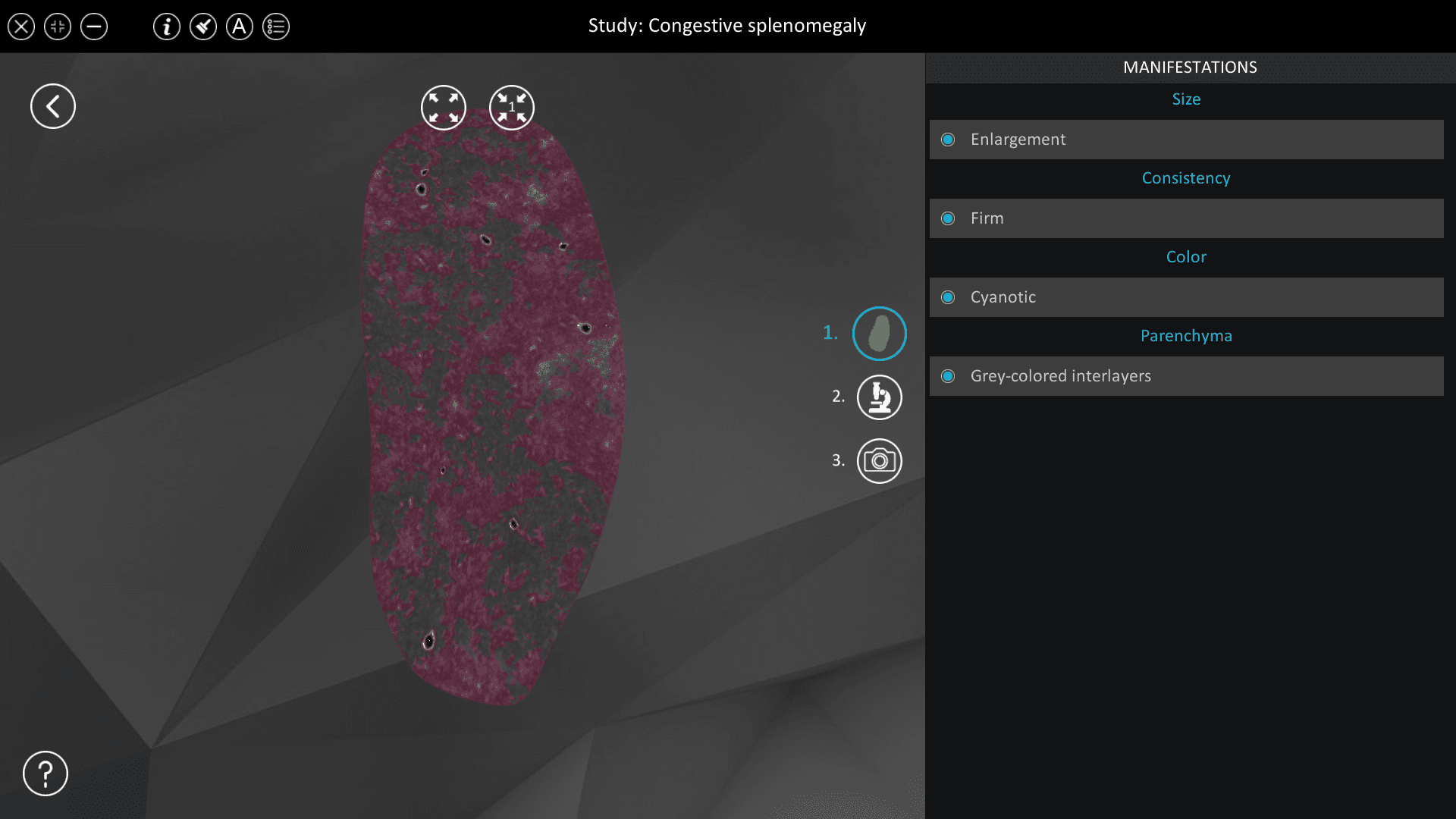 Congestive splenomegaly