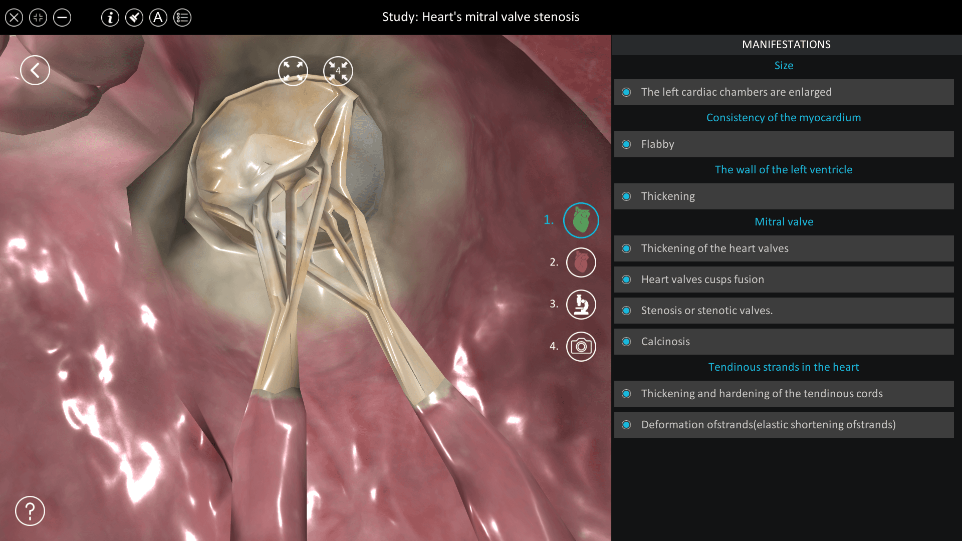 Heart’s mitral valve stenosis