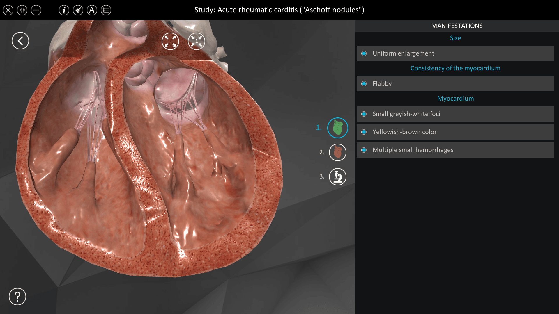 Acute rheumatic carditis (“Aschoff nodules”)