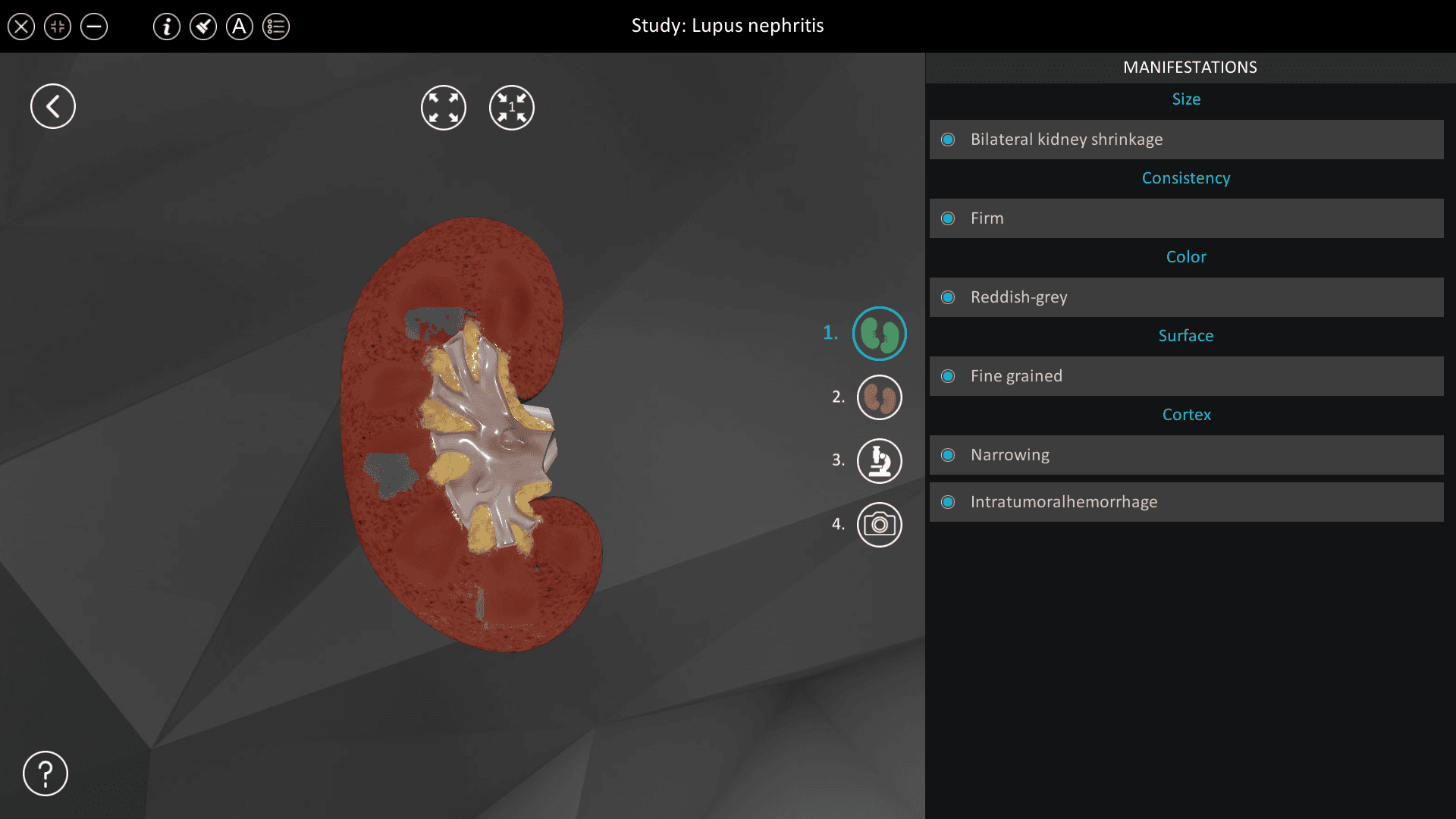 Lupus nephritis